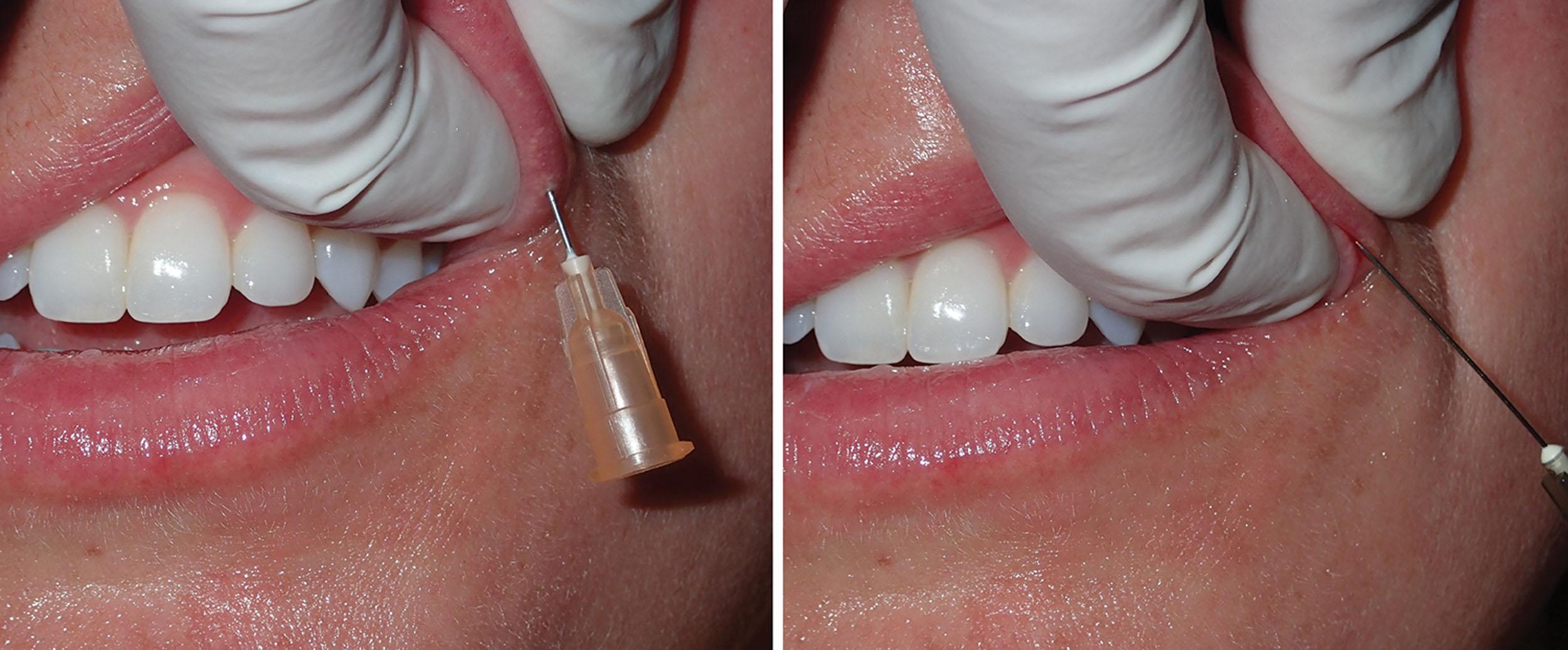 Fig. 10.24, The initial entry puncture with the sharp half-inch pilot needle (left) and the introduction of the blunt cannula into the previously made puncture (right) are shown.