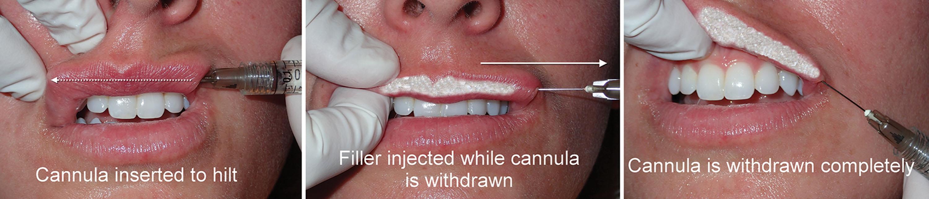 Fig. 10.25, The cannula is inserted across the entire length of the lip, which generally will contact the base of the cannula (left) . The filler is then injected as the cannula is withdrawn (center and right) .