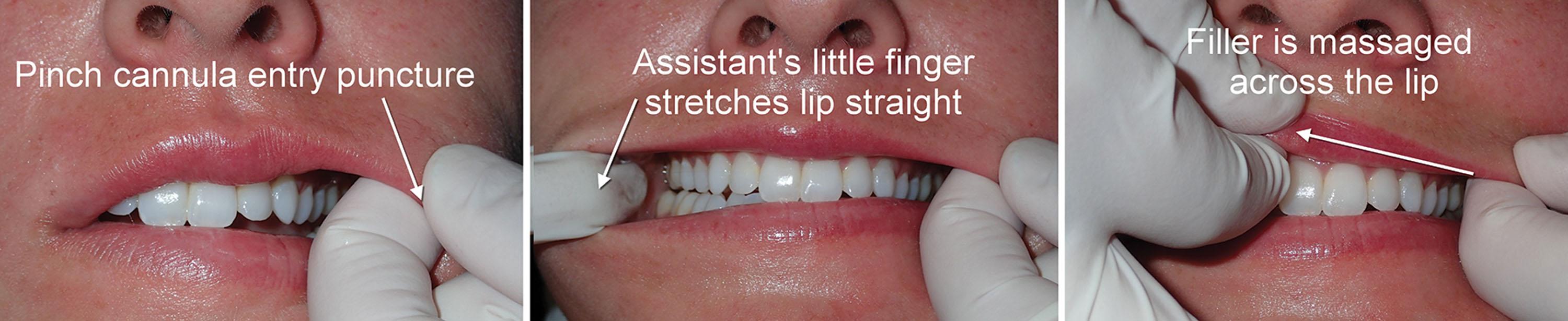 Fig. 10.26, Massaging the filler after cannula injection is also important but must be done in a controlled manner. Because there is an open puncture, the surgeon must pinch the oral commissure to prevent filler from extruding during massage (left) . It is of benefit if the assistant places their finger in the contralateral commissure and stretches the lip straight to facilitate gentle massage (center) . The filler is then gently massaged back and forth taking care not to extrude from the puncture site (right) . The same approach is performed in the lower lip, as shown in Figs. 10.27 and 10.28 .