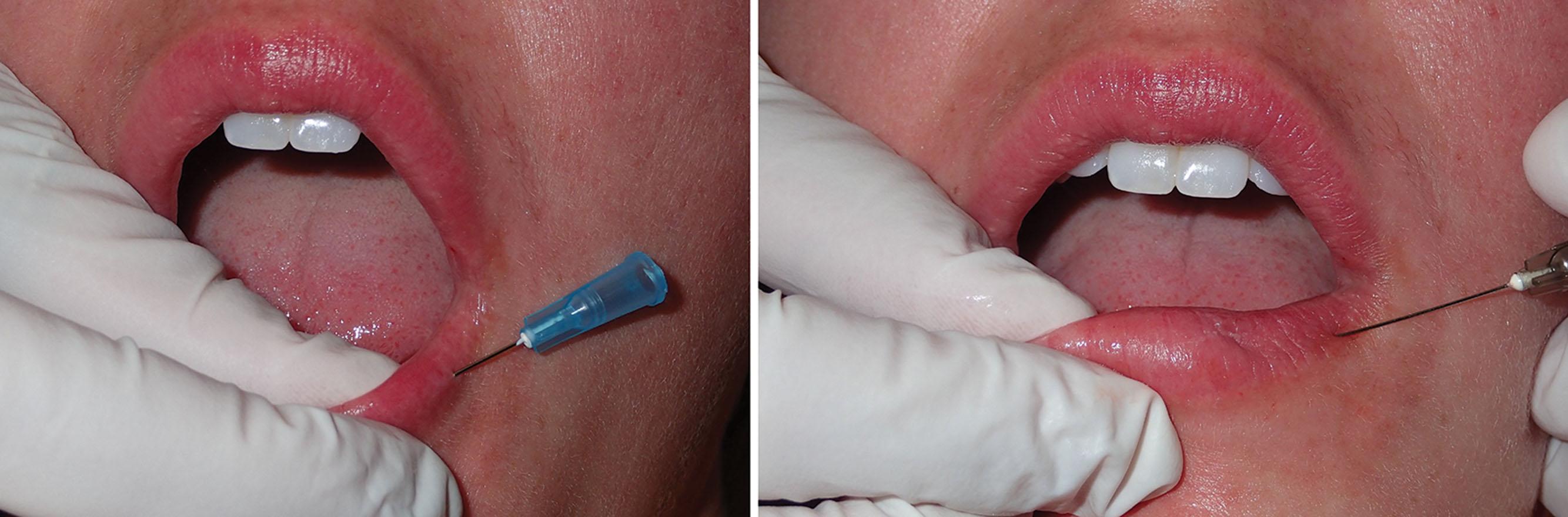 Fig. 10.27, The pilot needle is inserted (left) , and the cannula is inserted through the associated puncture (right) .