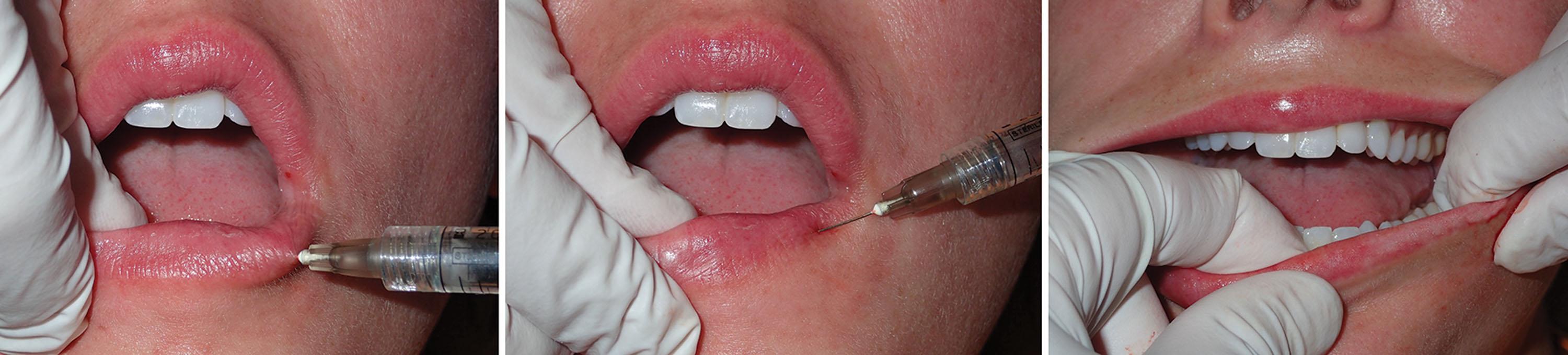 Fig. 10.28, The same technique of insertion (injection upon withdrawal and massage) are performed in the same manner as for the upper lip.