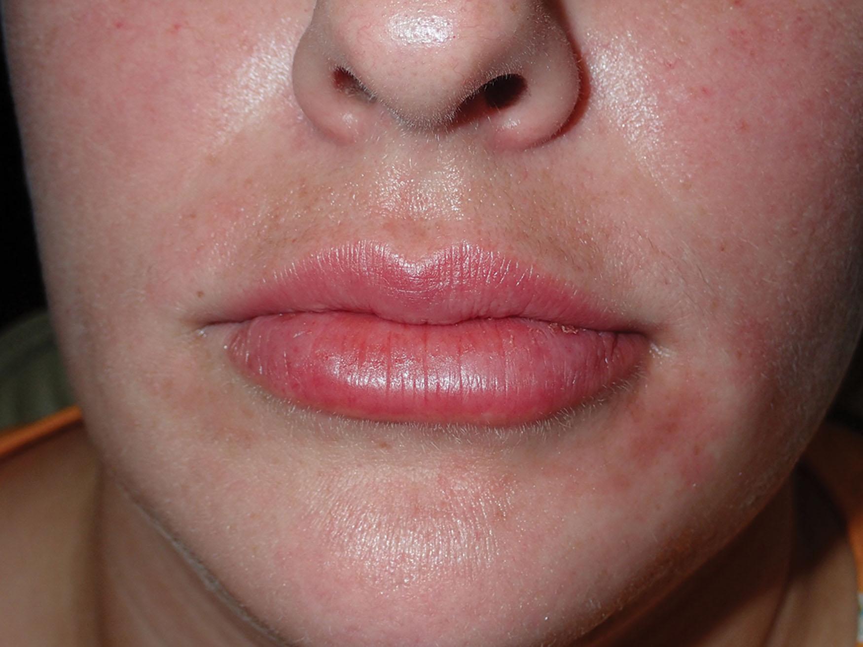 Fig. 10.29, This patient is shown immediately after 0.5 mL of hyaluronic acid filler was injected in each lip using the cannula method. Note the lack of swelling and bruising.