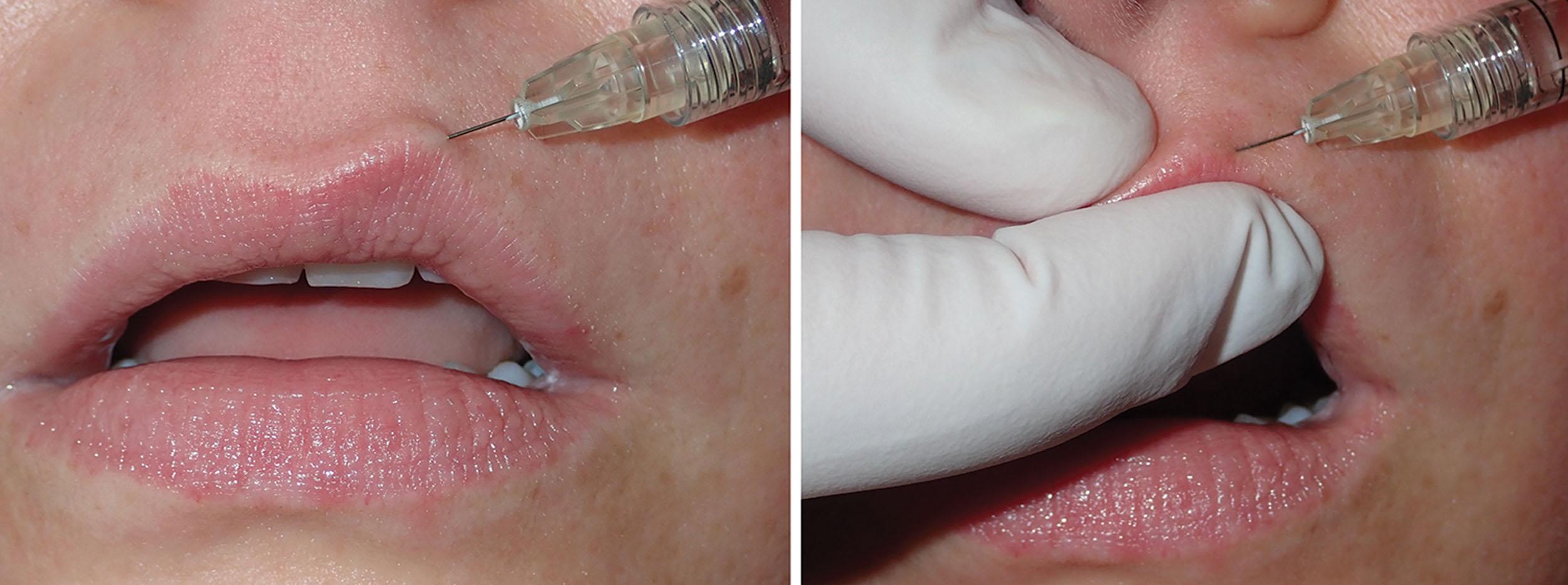 Fig. 10.30, The first outline injection is performed on one of the peaks of the Cupid’s bow (left) . The filler is being contained by the thumb and finger (right) .