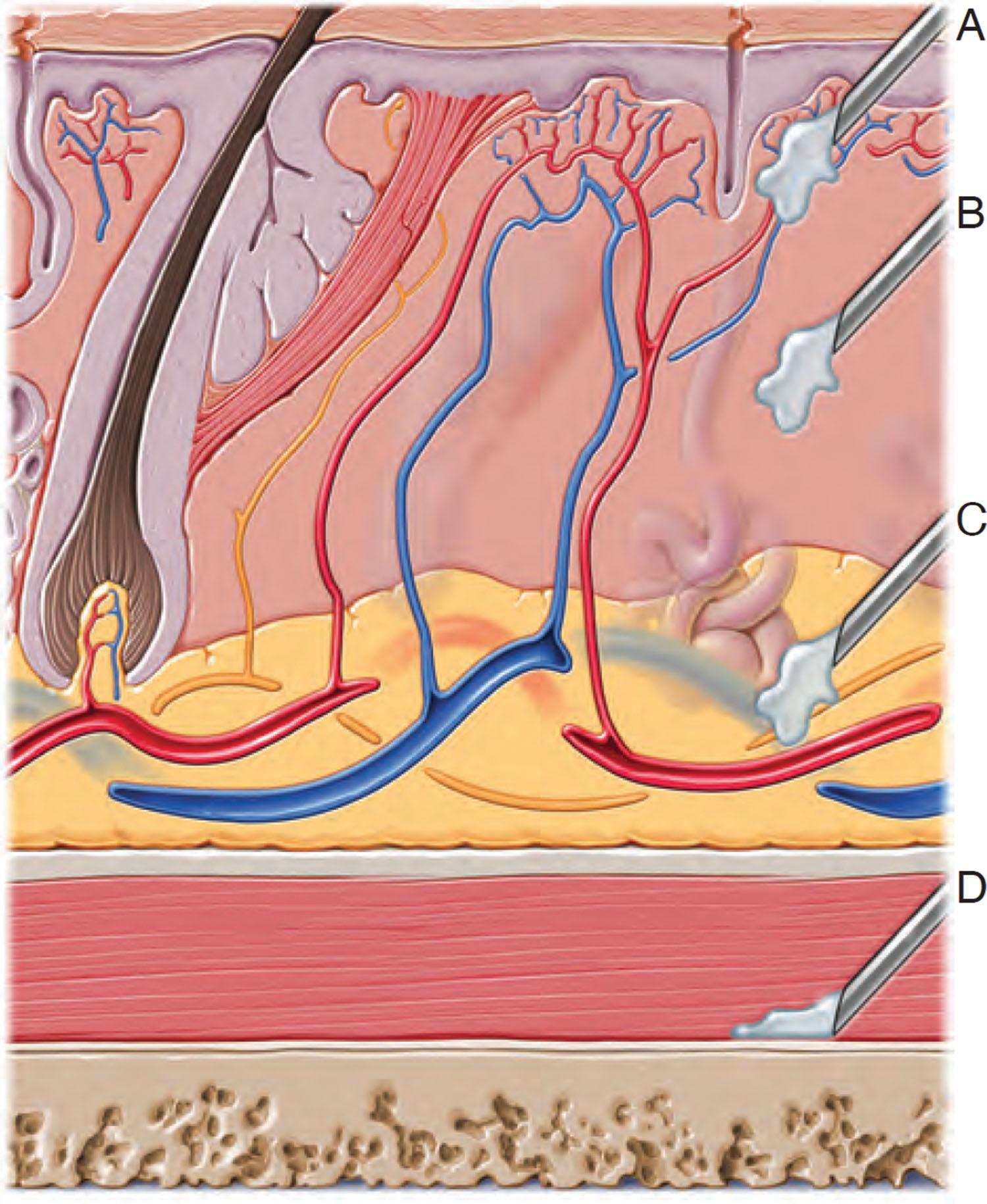 Fig. 10.3, Most fillers are engineered to be injected into specific tissue planes. These include the superficial dermis (A), the mid-dermis (B), the subcutaneous dermis (C), and the periosteal dermis (D). Although a thin filler in a deep plane or a thick filler in a very superficial plane may not be desirable, experienced injectors may customize how and where they place a given filler.