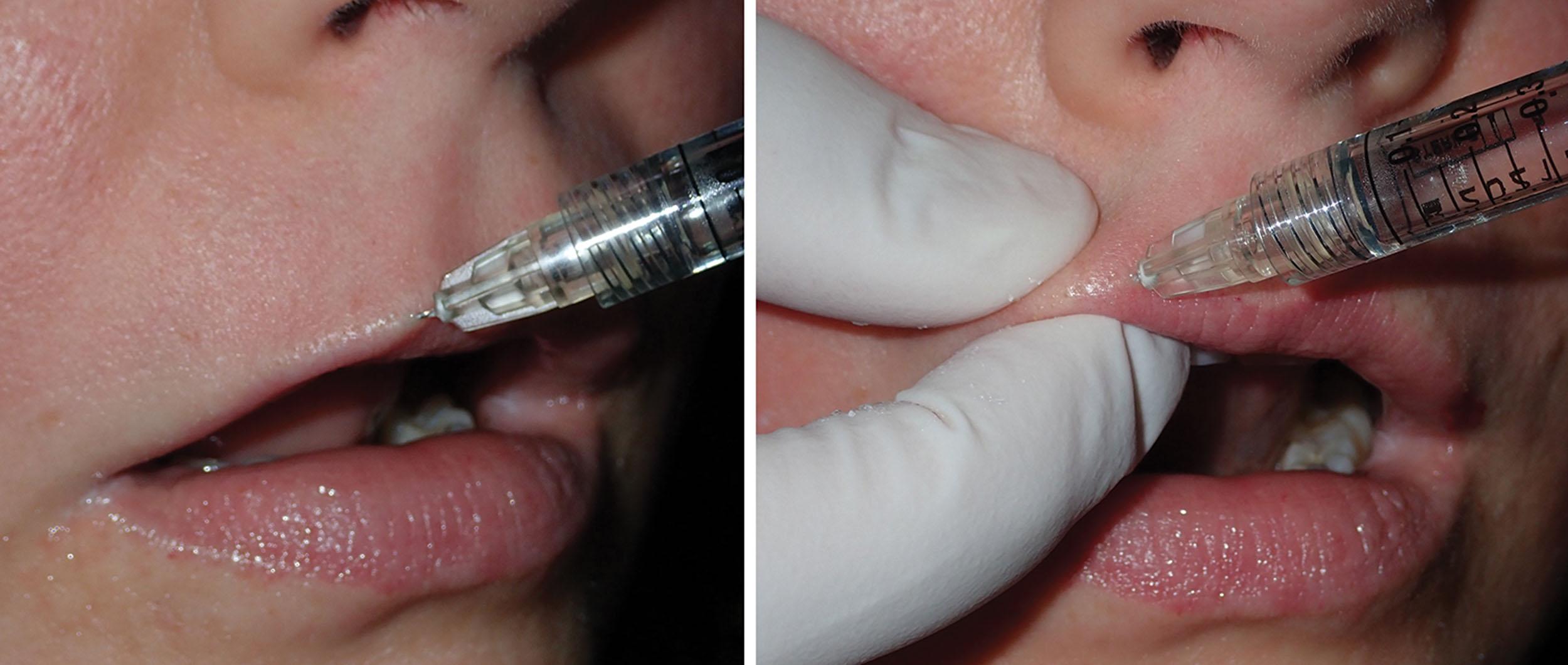 Fig. 10.31, The white roll outline augmentation progresses laterally (left) with finger containment (right) .