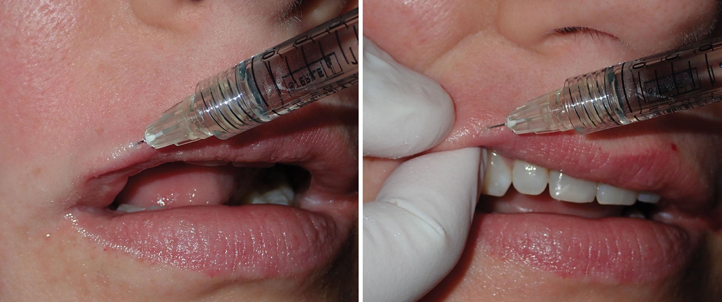 Fig. 10.32, The final step of the upper lip white roll augmentation is to carry the filler as far lateral as desired (left) . It is more aesthetic to stop short of the commissure in some patients, but extending to the commissure may be a better option in other patients. As with the previous techniques, there is finger containment of the filler (right) . This not only keeps the filler within the white roll but also provides palpation feedback for the injector.