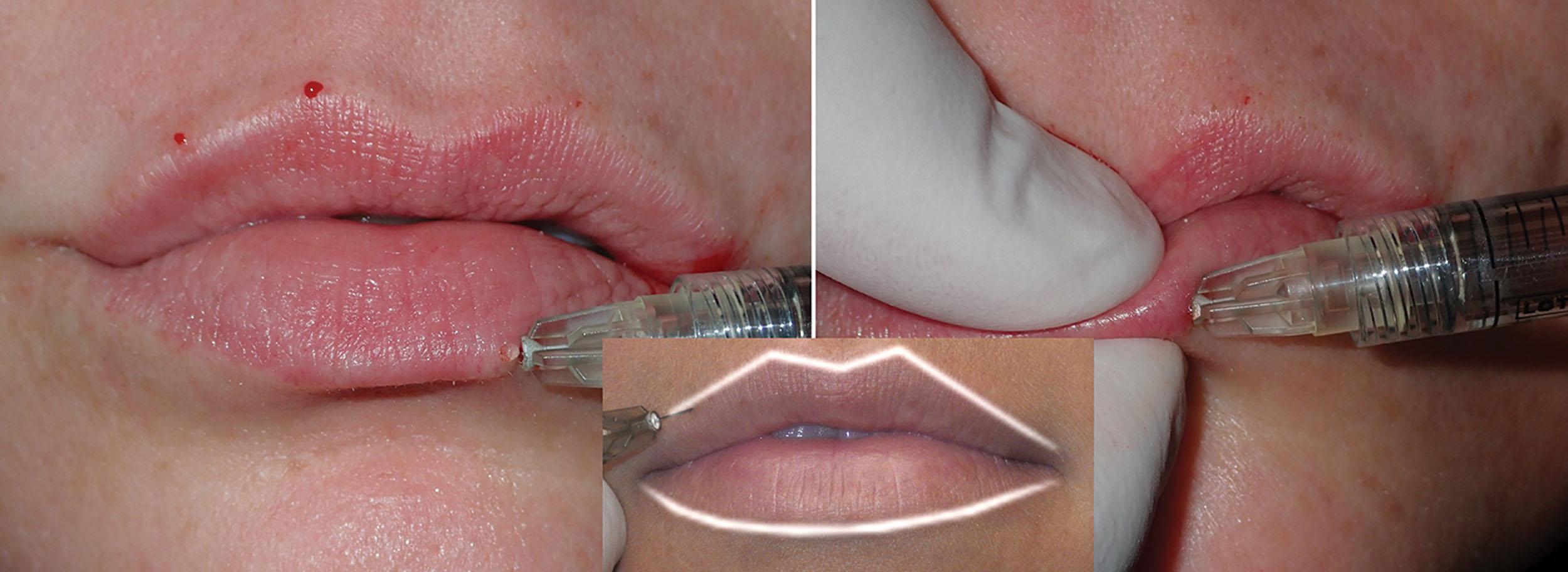 Fig. 10.33, This image shows the same method of injecting the potential space under the white roll for the lower lip. Looking closely at the left image, the observer can appreciate the augmented upper lip white roll and the central portion of the lower lip white roll. The inset shows the conceptualization of white roll outline augmentation.