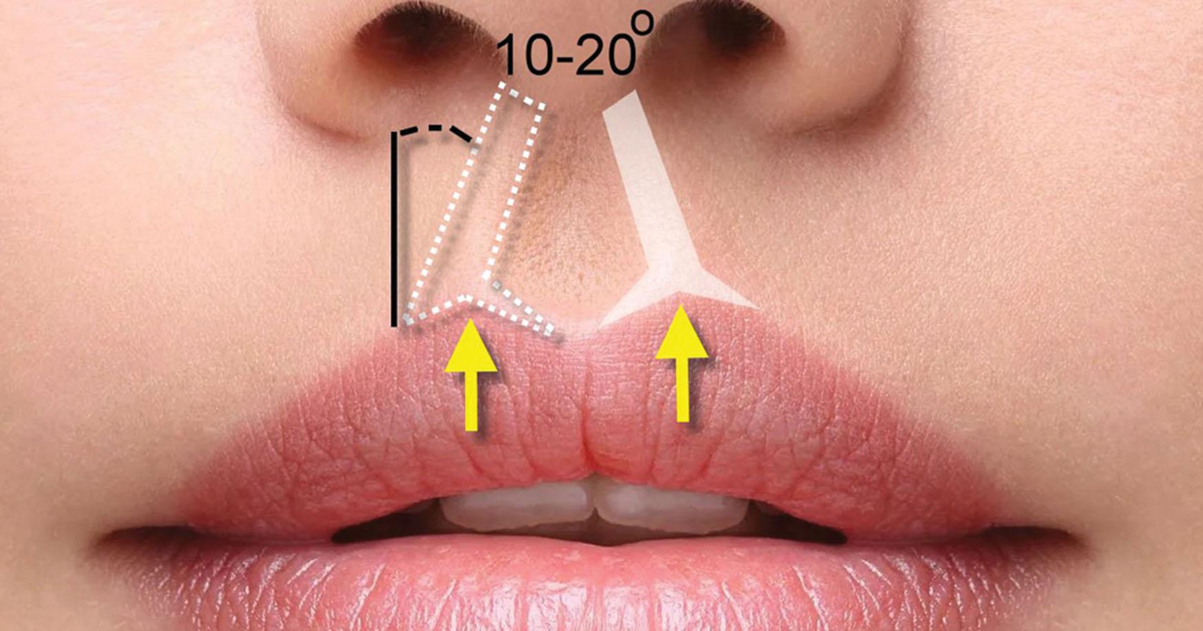 Fig. 10.34, The simple philtral columns have a complex anatomy that begins from the base of the columella and extends at a 10- to 20-degree angle from vertical to conform to the angled peaks of the central Cupid’s bow (yellow arrows) . A “teaspoon” depression is seen between the columns from the columella to the vermilion.