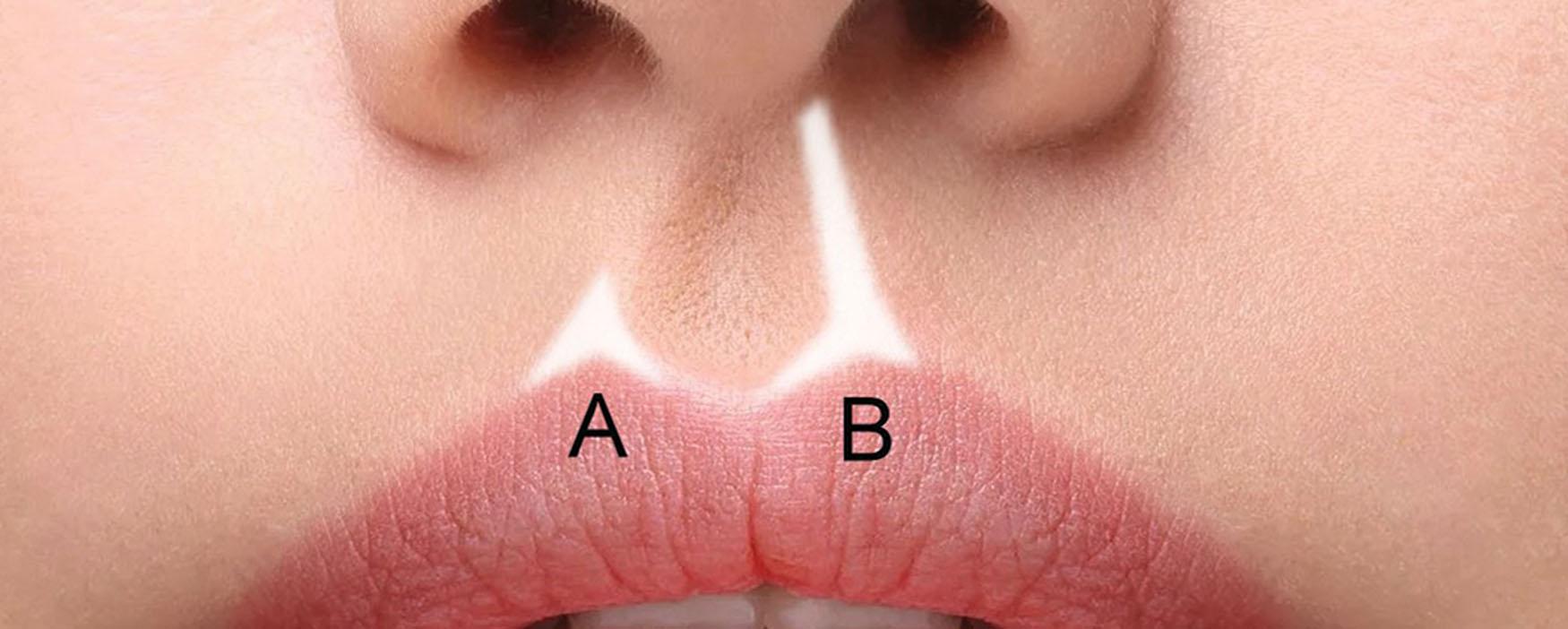 Fig. 10.35, (A) A small triangle of filler placed at the tip of the Cupid’s bow. (B) Injectable reconstruction of the entire philtral column is shown.