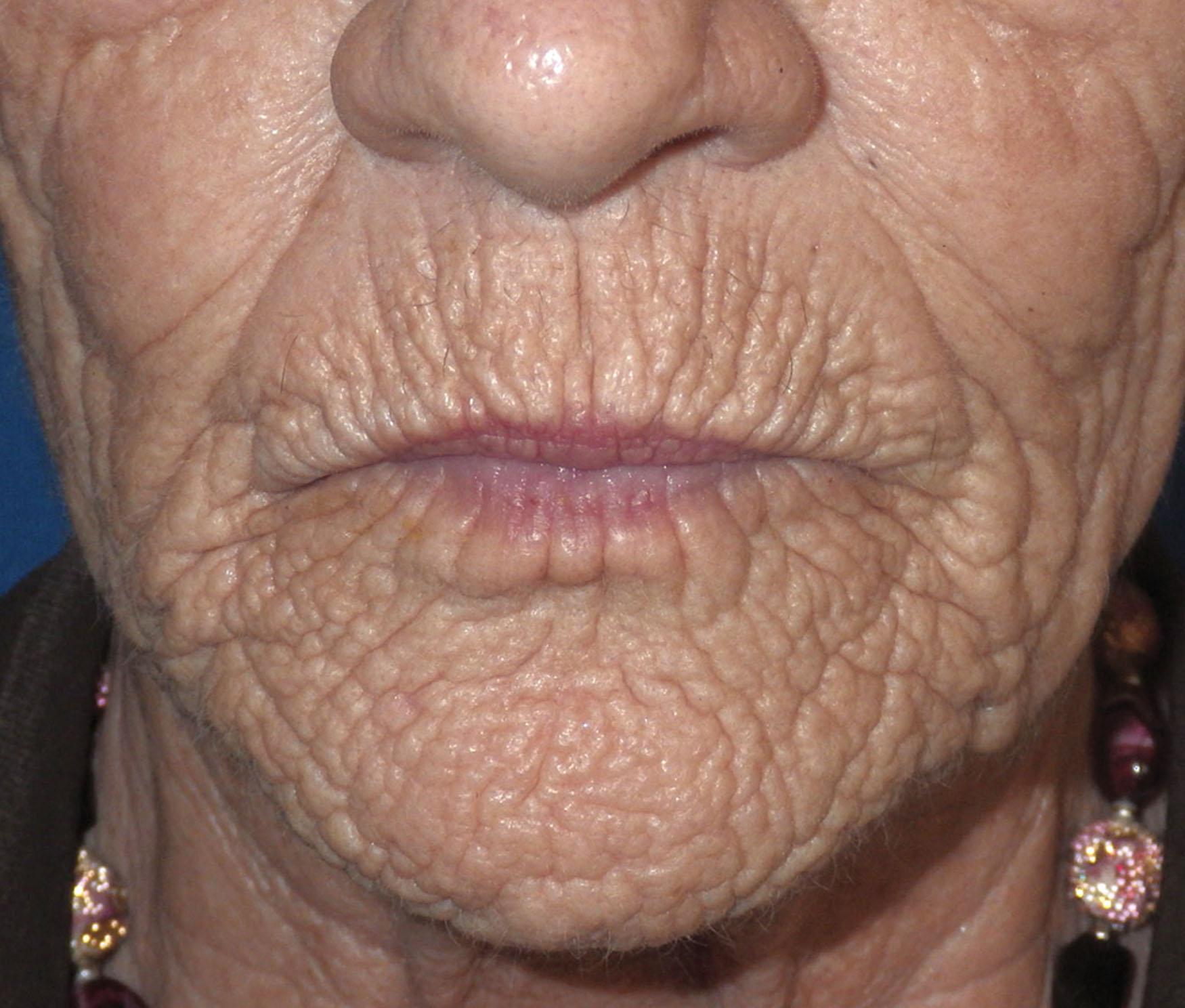 Fig. 10.37, Although not usually this severe, older women can develop significant vertical lines from factors including heredity, actinic damage, natural aging, smoking, or continual pursing of the lips.