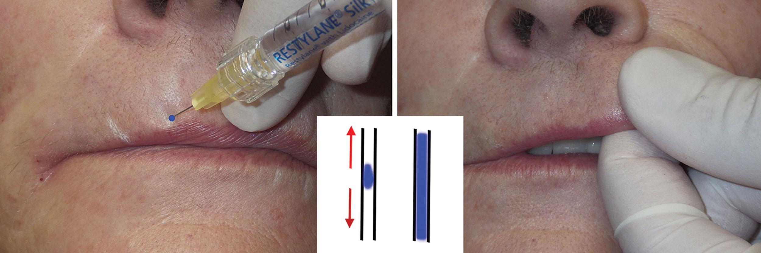 Fig. 10.38, The author’s (JN) preferred means of treating vertical rhytids is first to inject for lip volume and white roll, and then to address each deeper rhytid with a small bolus of filler and massage it along the length of the wrinkle. The inset shows a conceptualization of the filler bolus injected into the wrinkle (left inset) and massaged into the wrinkle (red arrows) to fill the vertical wrinkle (right inset) .