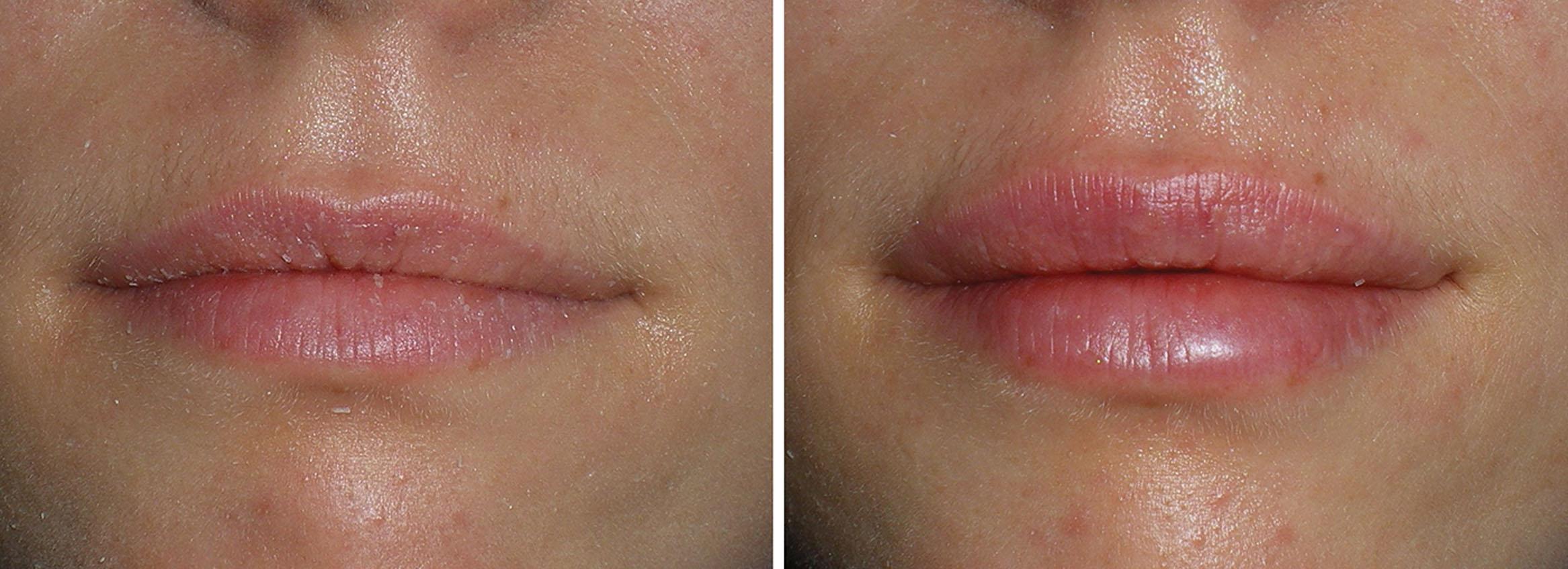 Fig. 10.39, This patient is shown before and after 2 mL of hyaluronic acid filler injected for volume and white roll enhancement.