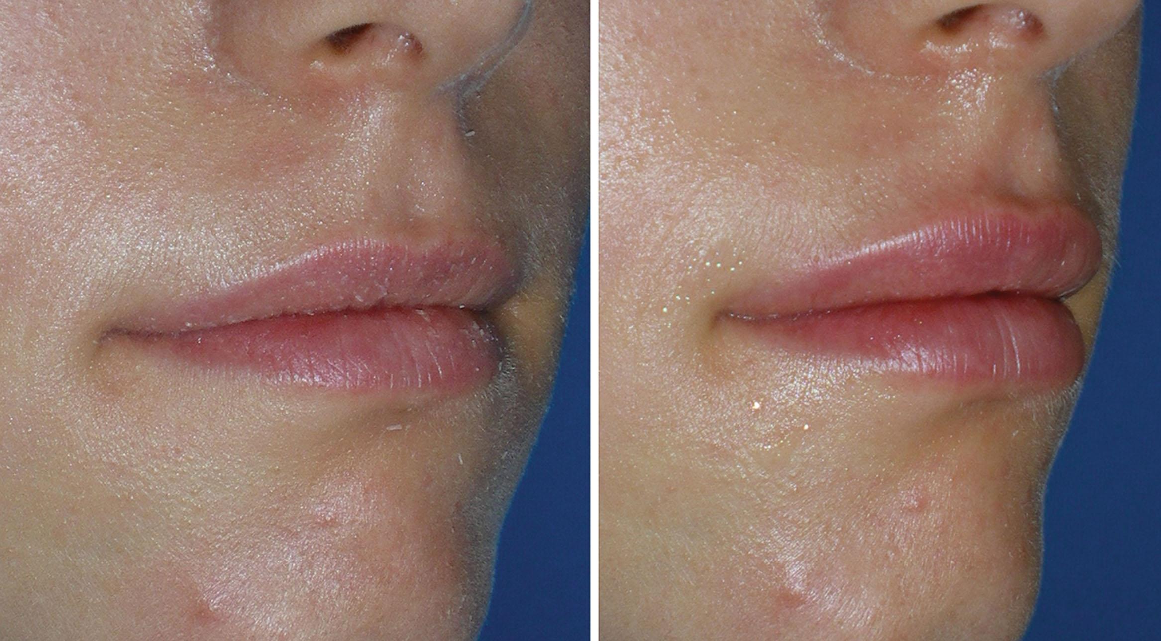 Fig. 10.40, This patient is shown before and after injection of 2 mL of hyaluronic acid filler for volume and white roll enhancement.