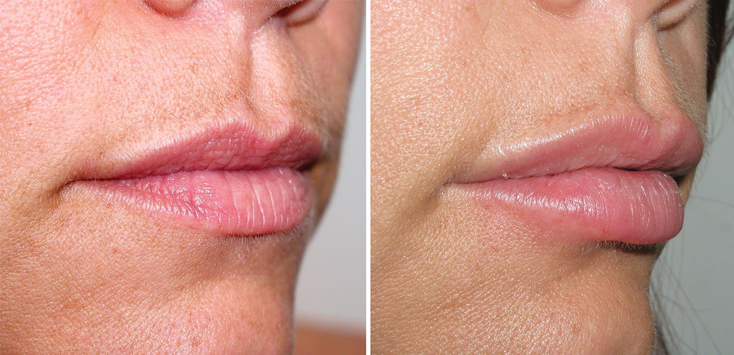 Fig. 10.41, This patient is shown before and after injection of 2 mL of hyaluronic acid filler for volume and white roll enhancement.