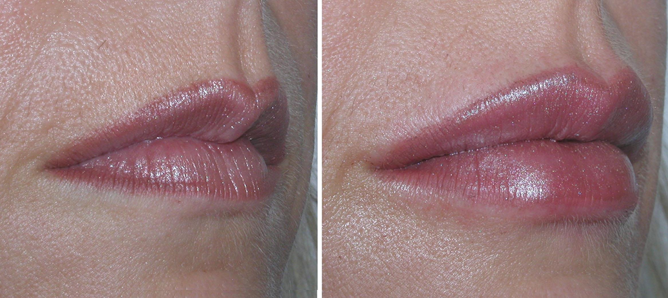 Fig. 10.42, This patient is shown before and after injection of 2 mL of hyaluronic acid filler for volume enhancement. This is a good example that patients with good pre-injection lip anatomy are easier to treat than older patients with severely deflated lips.