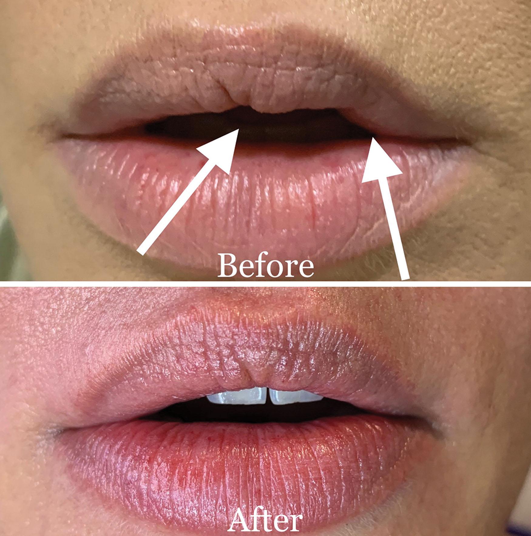 Fig. 10.43, This patient was injected with poor technique by another doctor (top) and retreated after dissolving all existing filler and performing proper injection techniques (bottom) .