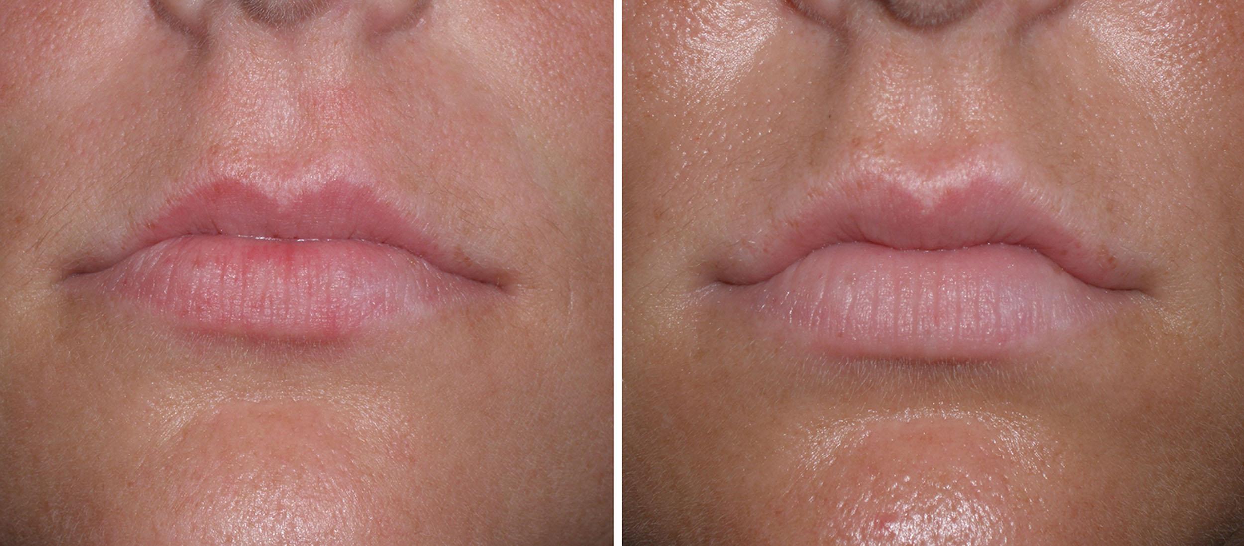 Fig. 10.44, This patient was treated with 2 mL of hyaluronic acid filler.