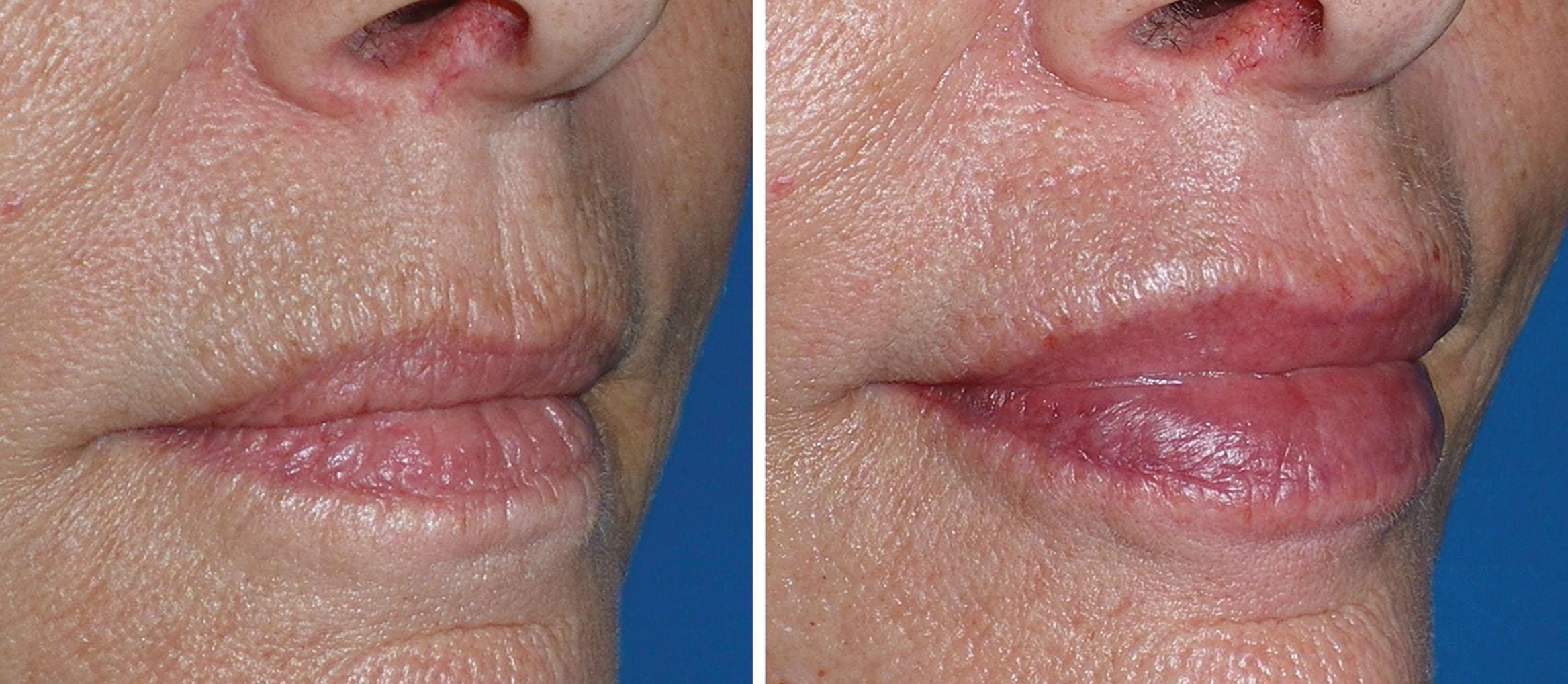 Fig. 10.45, Older female patients can present a treatment challenge. This patient was treated to increase lip volume, mitigate perioral lines, and improve oral commissures. She was treated with 3 mL of hyaluronic acid filler over 2 injection sessions.