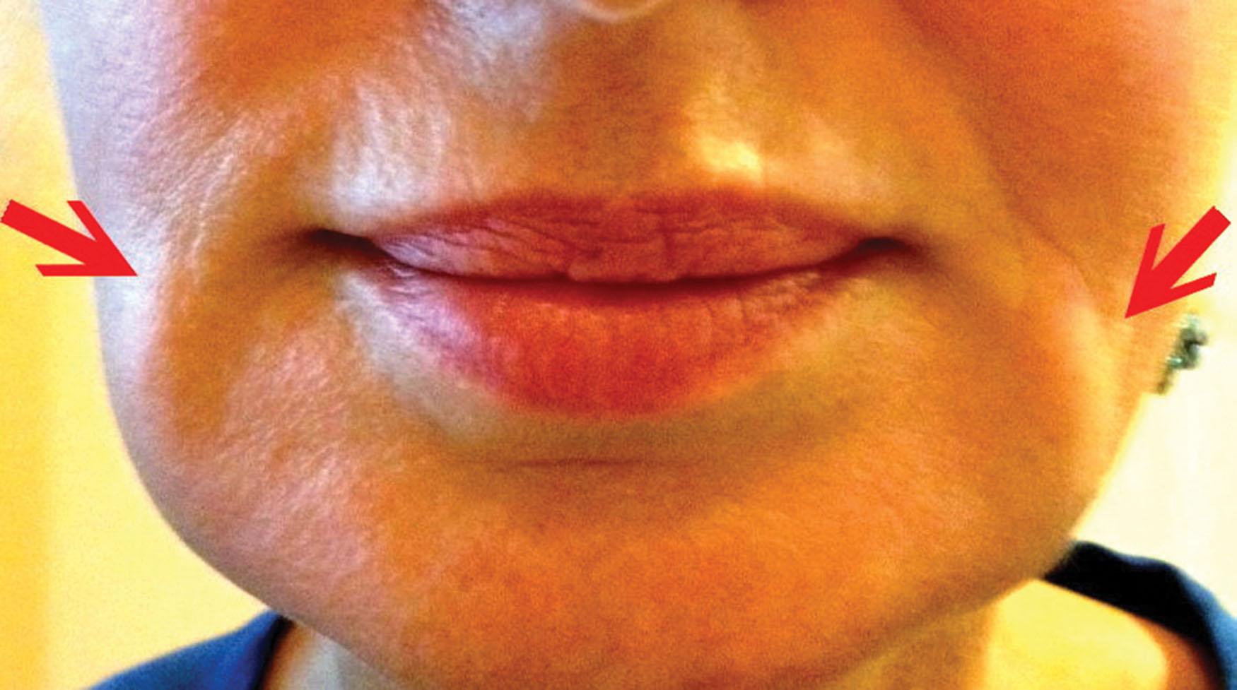 Fig. 10.47, This patient was injected elsewhere and was referred for “infection.” The problem was simply lateral migration of the filler from improper injection technique. The existing filler was dissolved, and the patient successfully retreated with proper technique.