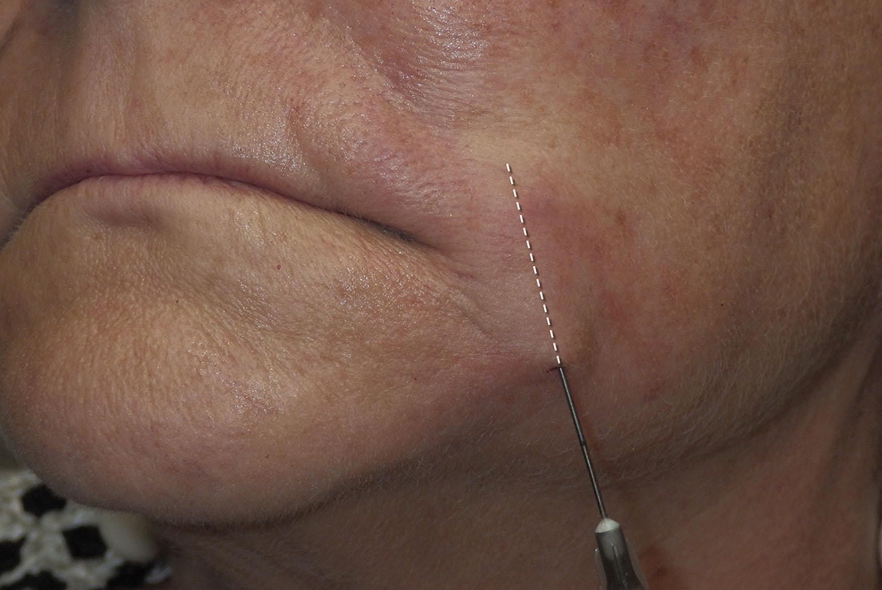 Fig. 10.49, A blunt cannula or a cannula and filler needle can be used to treat the perioral region.