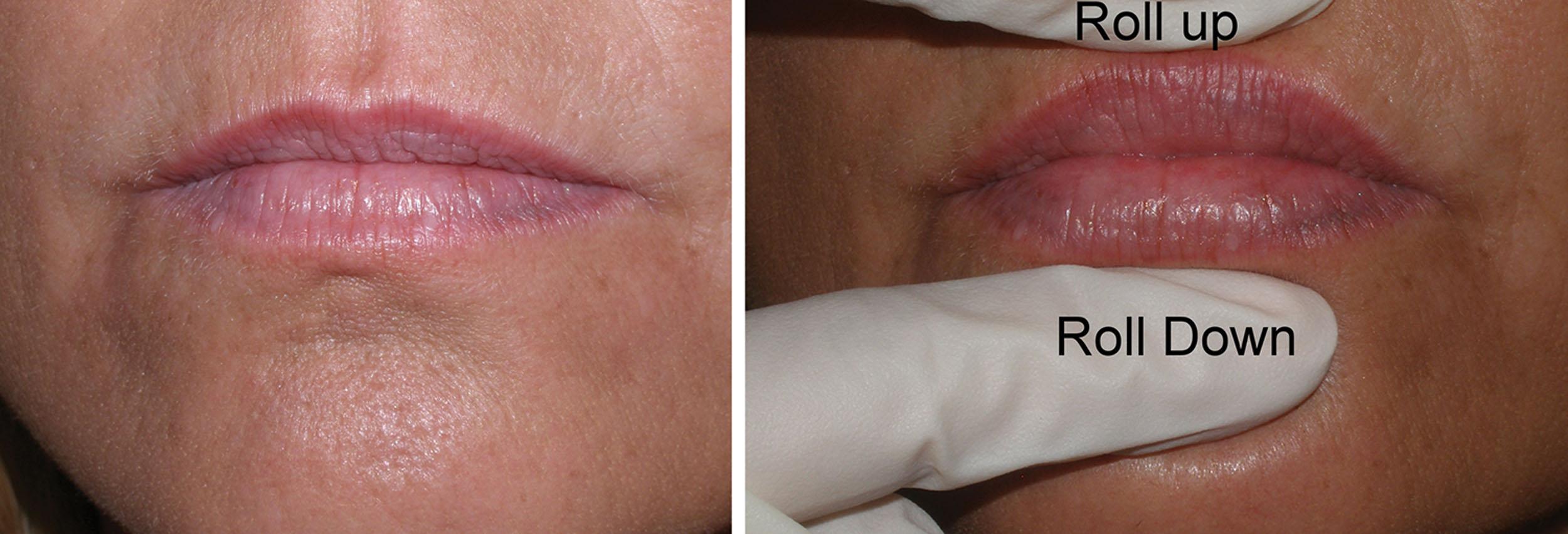 Fig. 10.5, Placing a finger above and below the vermilion portion of the lip and rolling the skin away from the lip produces a larger vermilion surface, which can give the patient an idea of the predicted outcome of lip filler for volume increase.