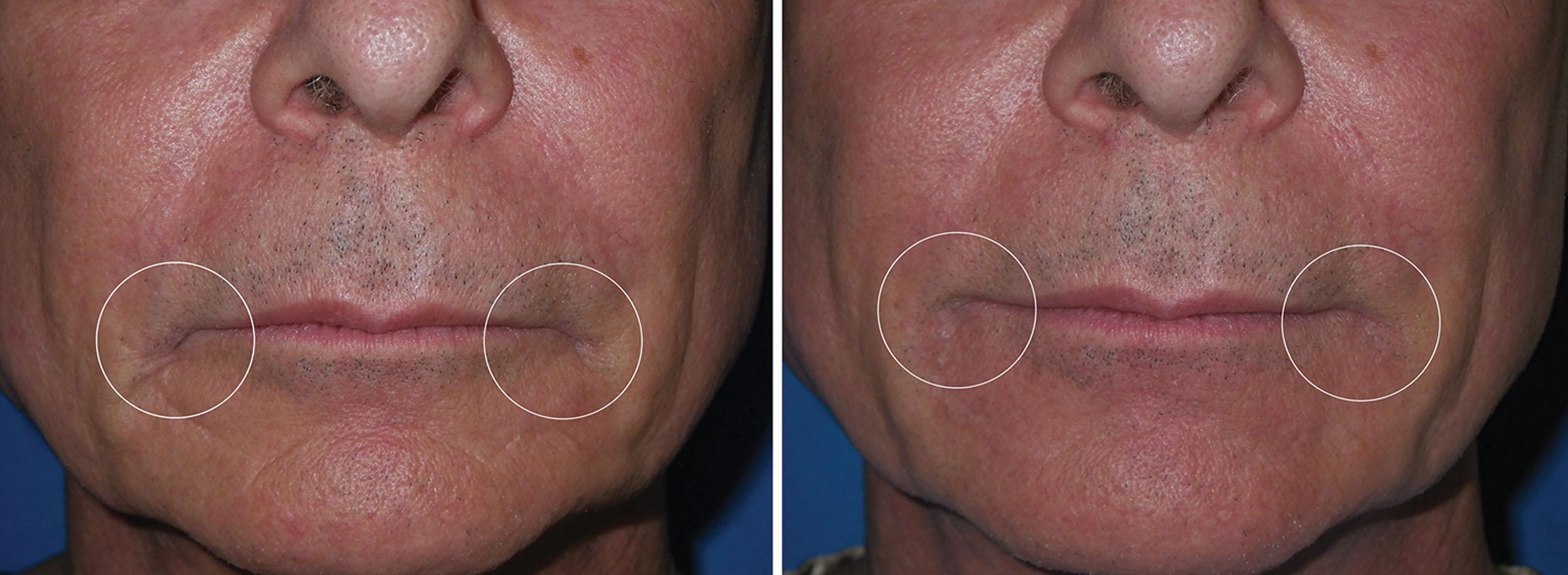 Fig. 10.51, A patient with established melolabial folds that became irritated from salivary accumulation and yeast formation (left) . The same patient 1 week after filler injection to the region (right). This lessens the depth of the fold and hence creates less of a salivary trap and yeast habitat.