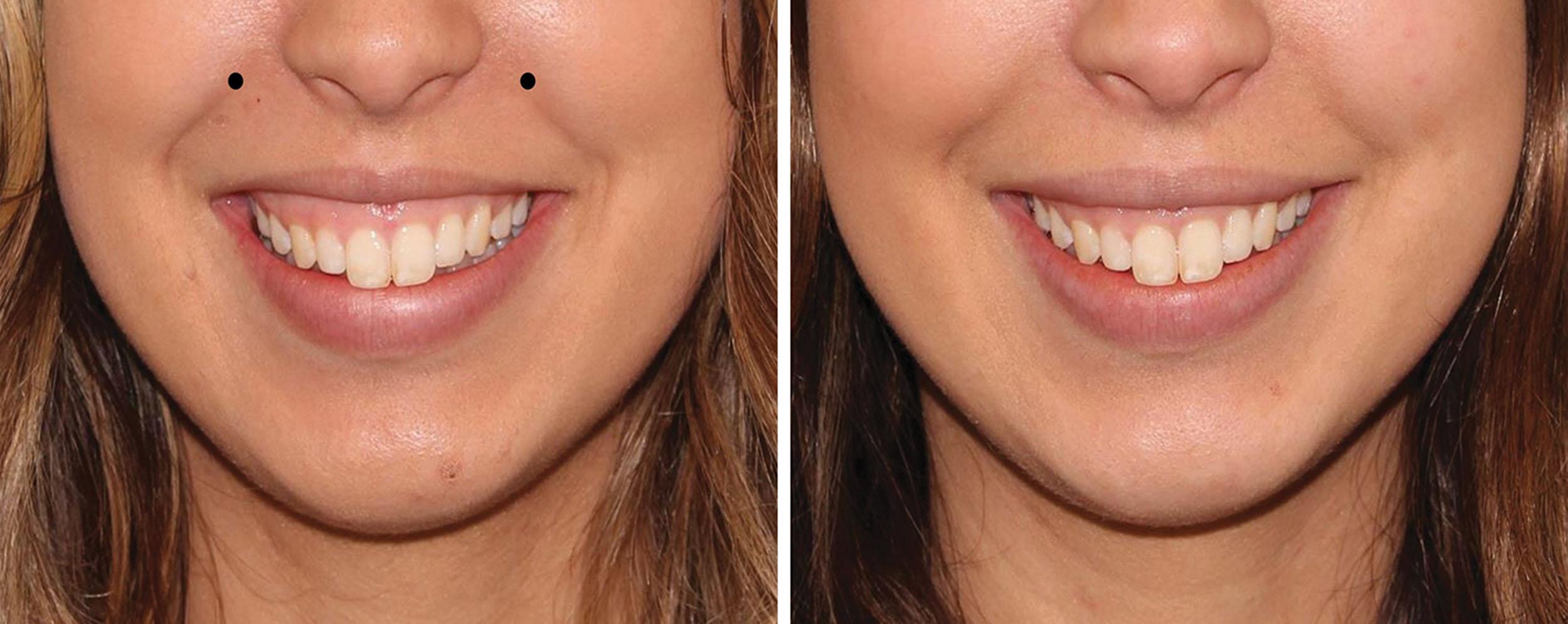 Fig. 10.55, This 25-year-old patient was unhappy with her thinning upper lip and excessive gingival display when smiling. Treatment with botulinum toxin made a significant contribution to the aesthetics of the case. It was recommended to first treat her gummy smile with neurotoxin before or during the filler injection appointment. The patient is shown before treatment with neurotoxin (left) and 2 weeks after injection (right) .