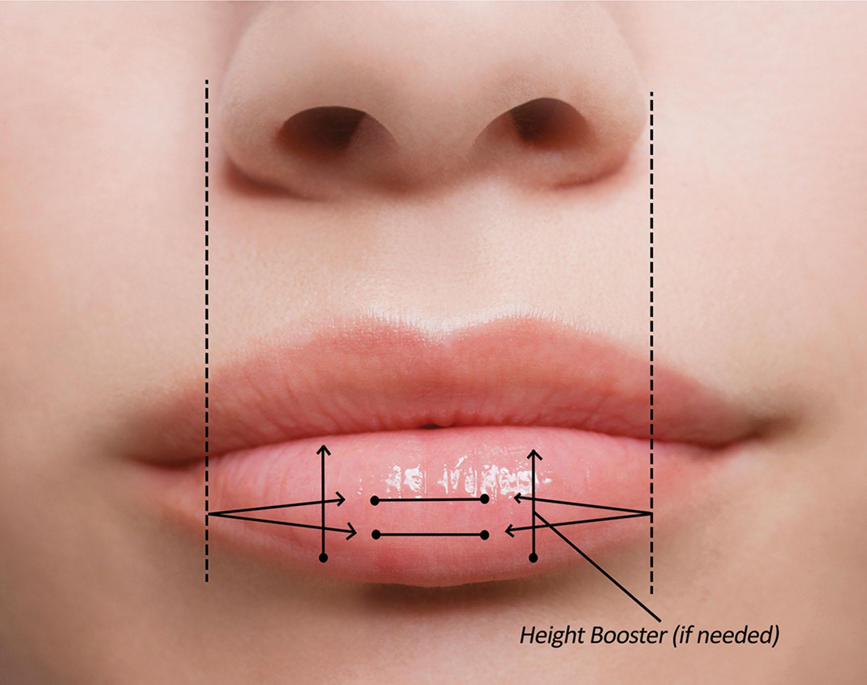 Fig. 10.56, Lower lip injection techniques and landmarks are shown.