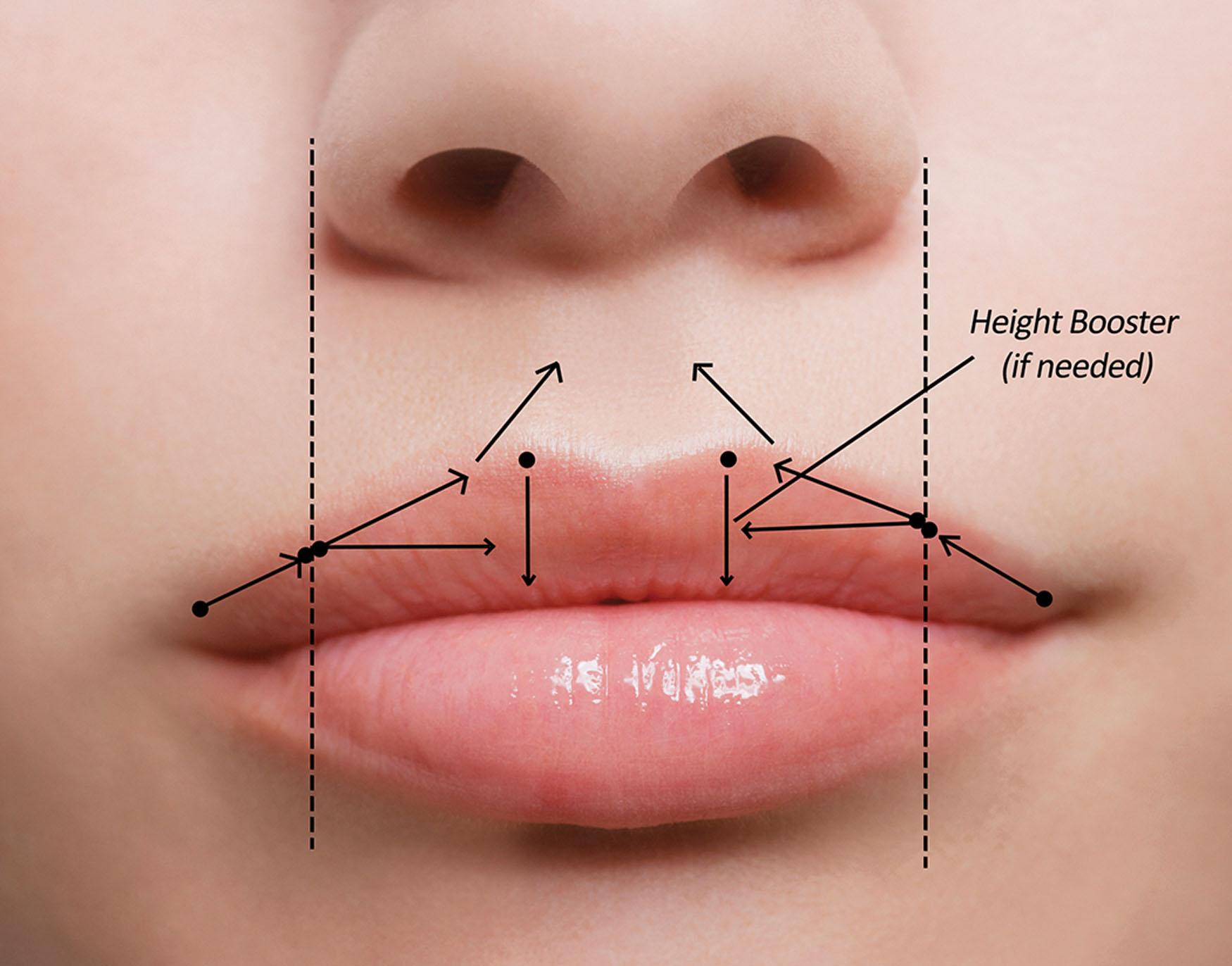 Fig. 10.57, Upper lip injection vectors and landmarks are shown in a youthful and aesthetic lip.