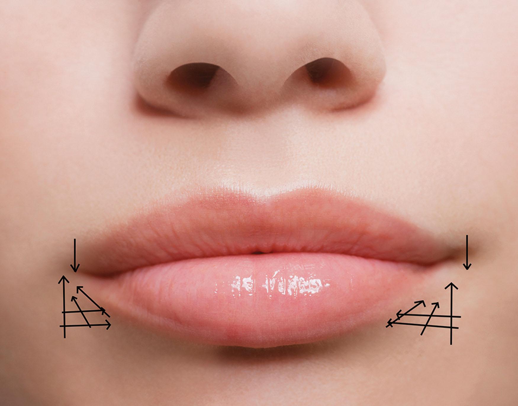 Fig. 10.58, The cross mattress injection technique to address oral commissures is shown. The arrows indicate the direction of the filling.