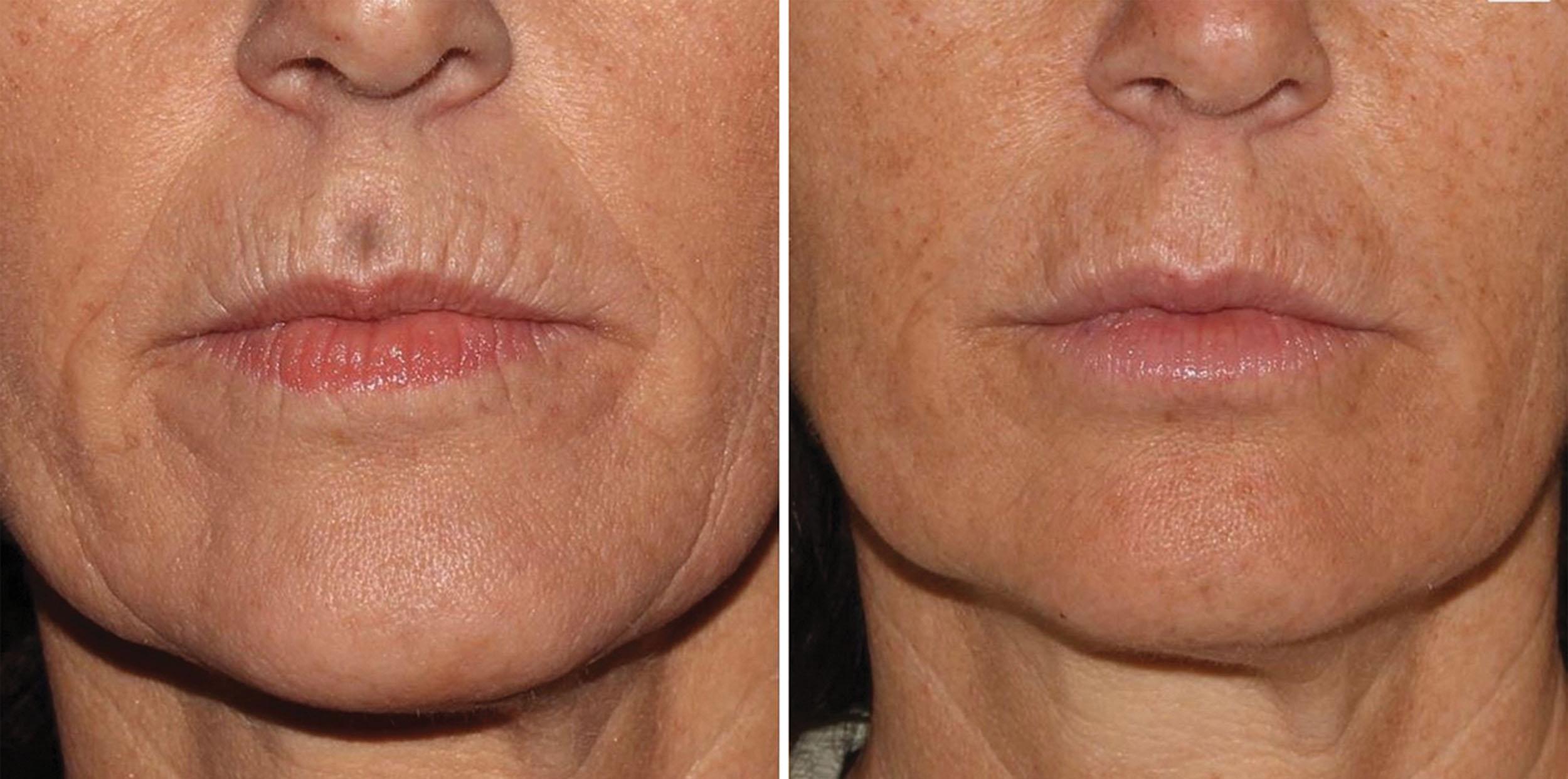 Fig. 10.59, This 54-year-old patient desired improvement of her smoker lines without enlarging her lips or looking unnatural. The patient received an injection of 0.7 mL of hyaluronic filler at the vermilion borders, which reduced the vertical smoker lines by 80%. An additional 0.5 mL was targeted in microdroplet technique for the remaining vertical rhytids and nasolabial fold. A single 1-mL syringe of hyaluronic acid filler was conservatively injected into the oral commissures. A total filler volume of 2.5 mL was used for the entire lower perioral region.