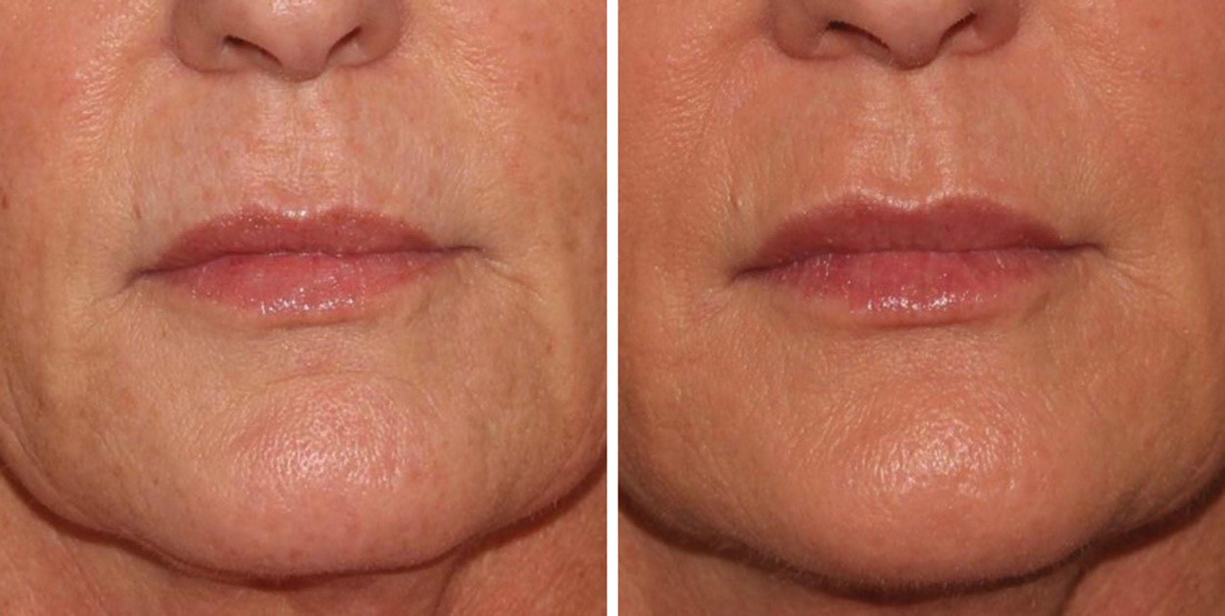 Fig. 10.60, This 55-year-old patient requested overall natural rejuvenation. The patient received an injection of 1 mL of hyaluronic acid filler to correct overall lip and oral commissure with the techniques described in this chapter.