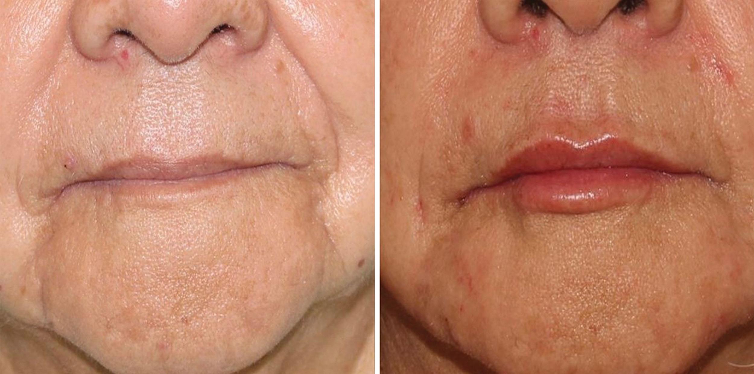 Fig. 10.62, This 79-year-old patient presented with a photo of Khloé Kardashian’s lips from a magazine and requested that result. Although she did not accomplish that fullness, she was happy with her first-ever lip injection and will return in 1 month for another. An additional 2 mL were used to treat the nasolabial folds and oral commissure.