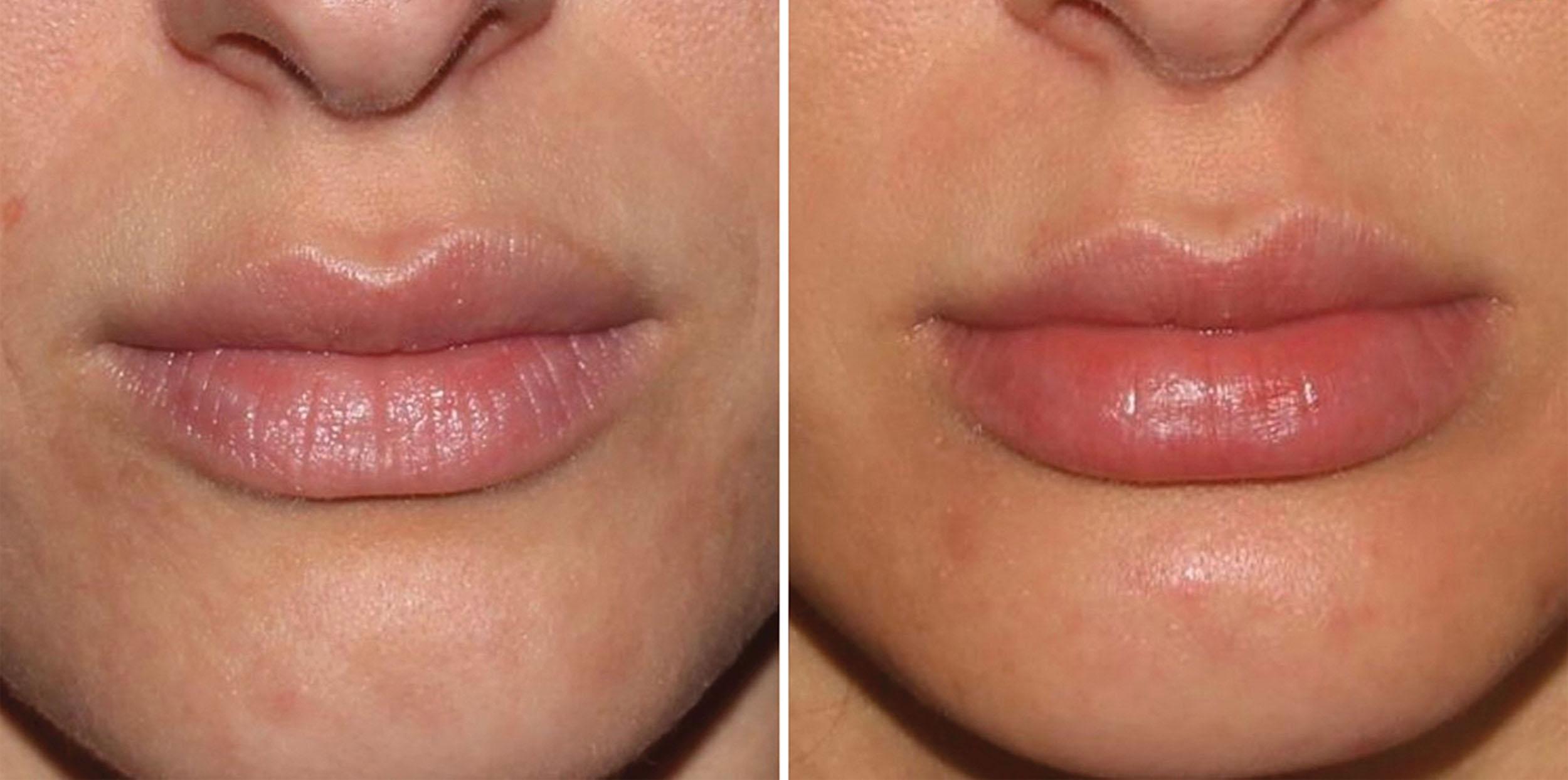 Fig. 10.63, This 32-year-old patient has naturally large lips but wanted them enhanced and with more symmetry to the upper lip.