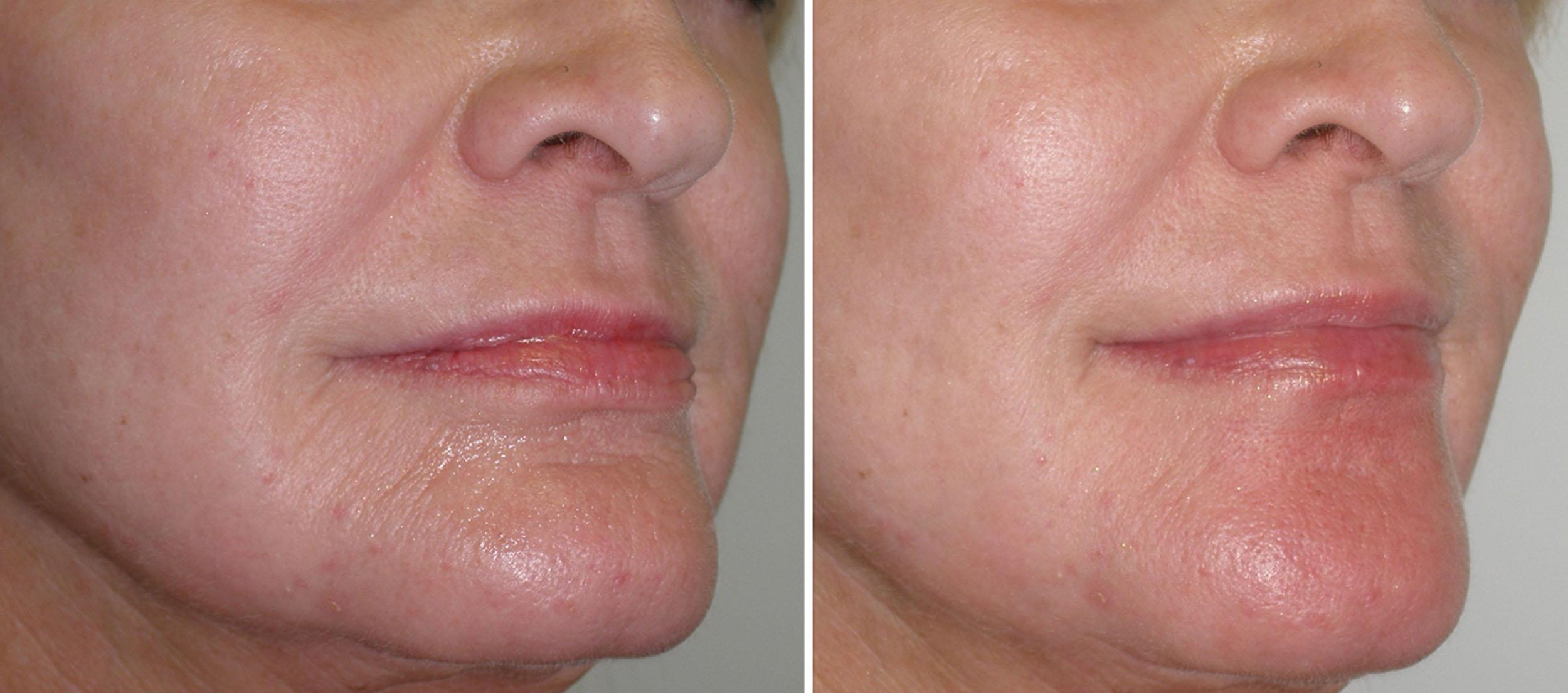 Fig. 10.65, This patient was treated by the author (JN) with 3 mL of hyaluronic acid filler.