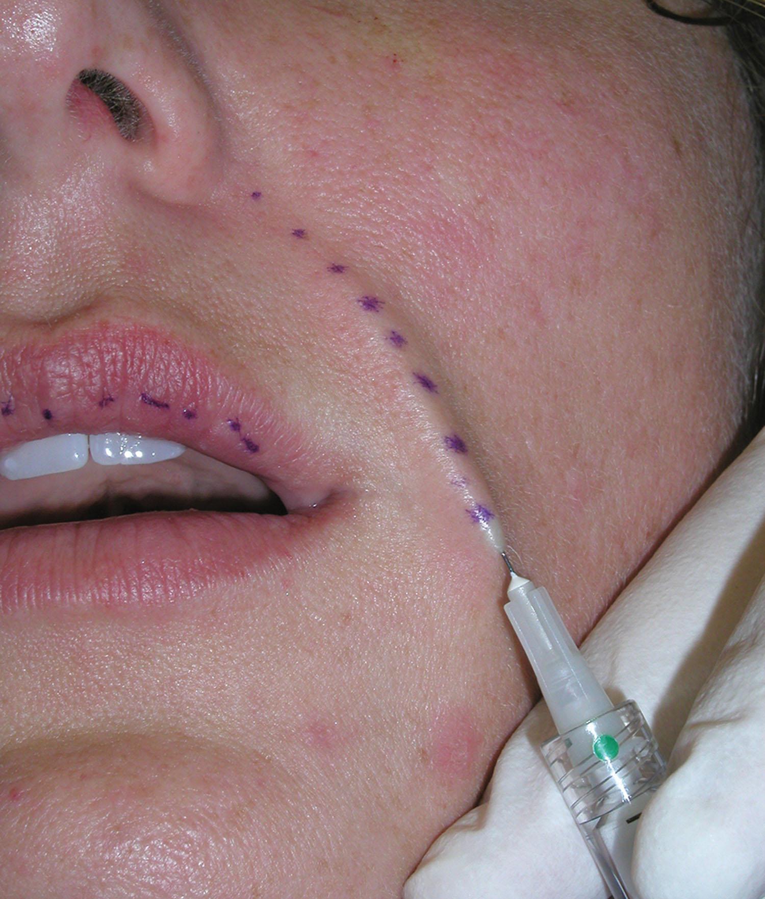 Fig. 10.66, Younger patients tend to have shallower nasolabial folds and can be treated with less filler. The target in this type of patient is mid to superficial dermis as small augmentation of this plane can provide adequate fill in this age group.