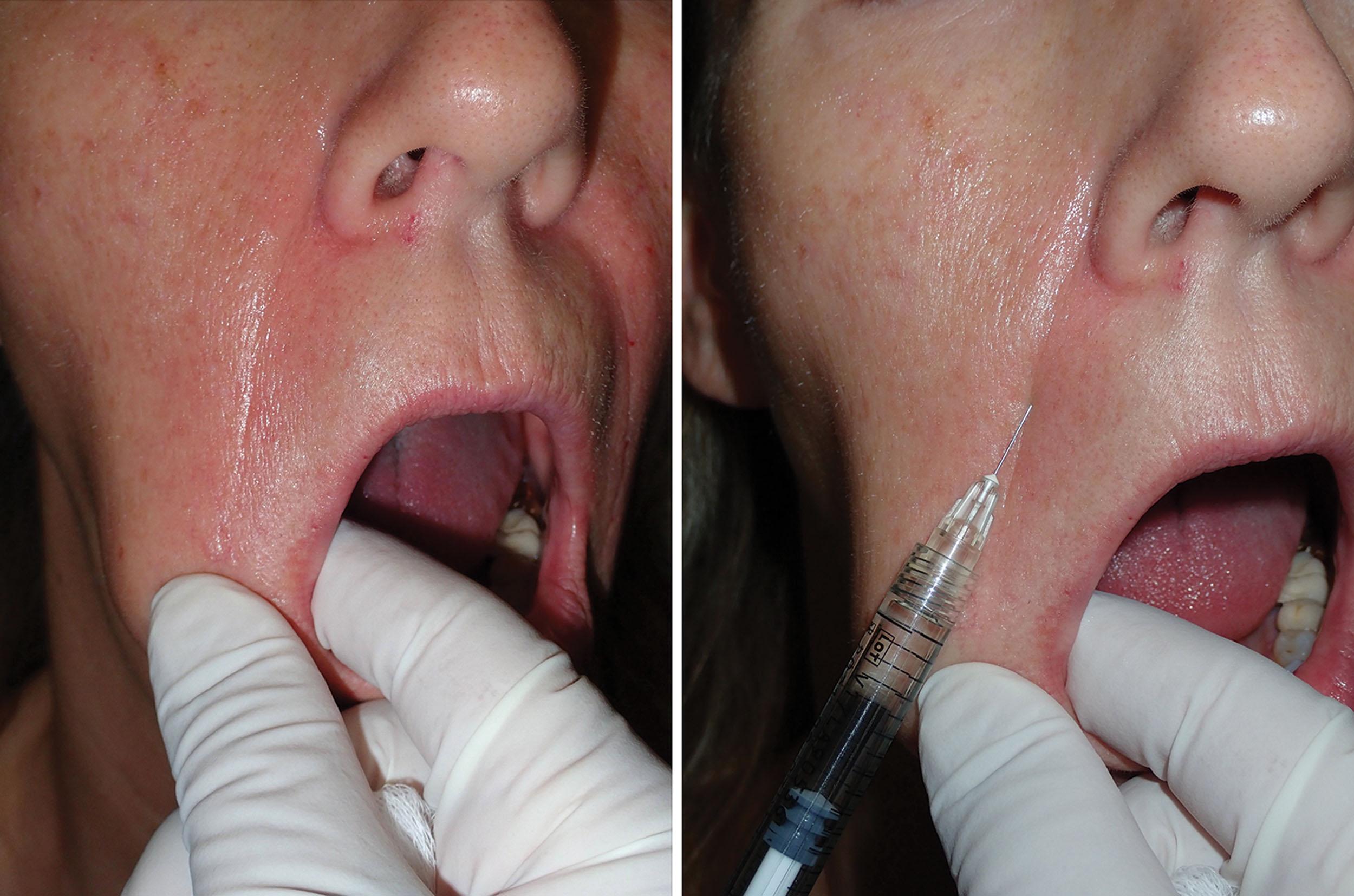 Fig. 10.68, Placing the nasolabial fold on stretch can turn the curvilinear fold into a straight line, thus facilitating injection.