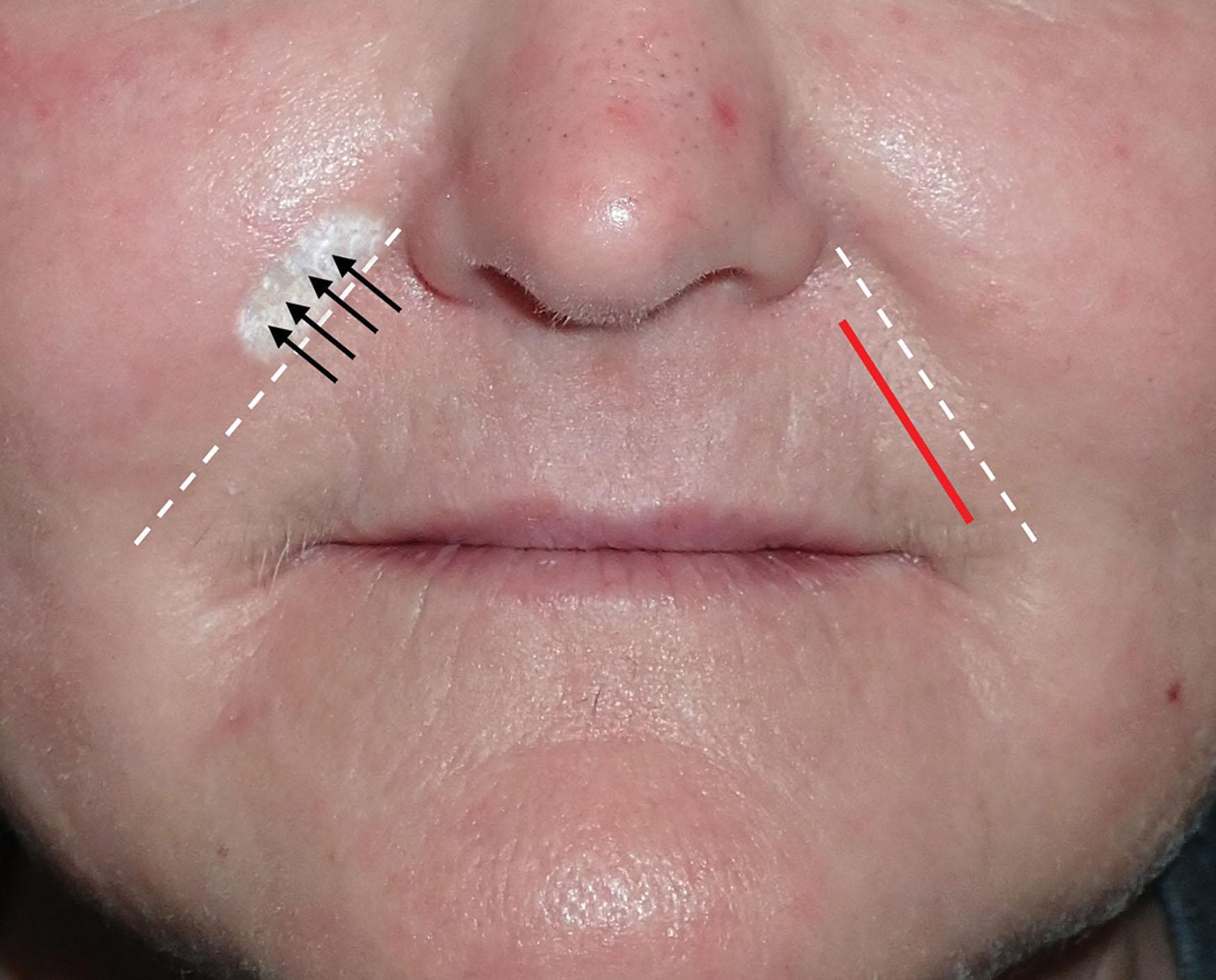 Fig. 10.69, Filler injected in the center of the nasolabial fold (dashed white line) can flow laterally, which can worsen the fold (left) . It is important that the injector continually watch where the filler is going during injection. If the filler appears to flow laterally, the needle can be placed more medially to compensate (red line, right) .