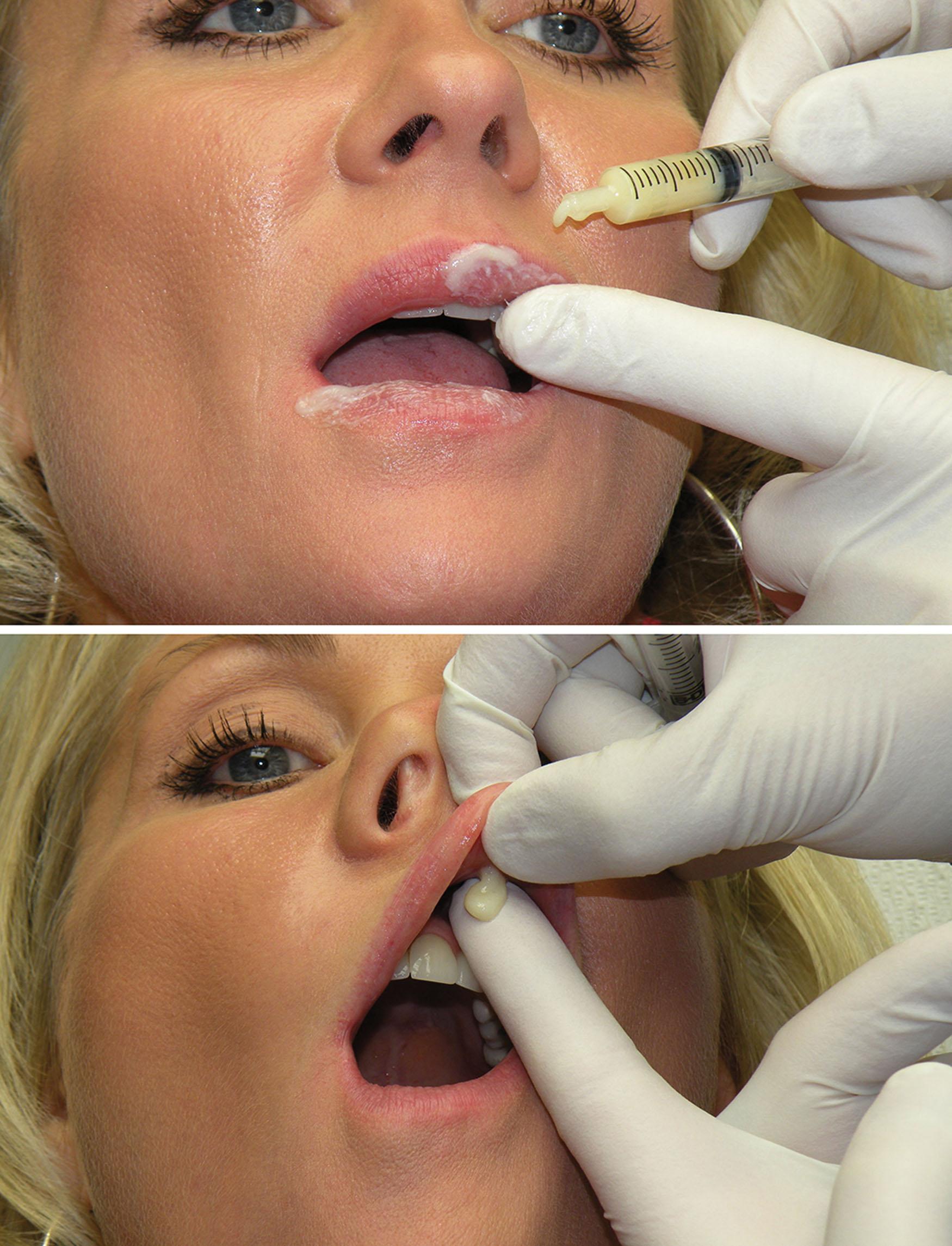 Fig. 10.7, A topical anesthetic is placed immediately after the patient decides on a treatment plan and is left in place for 10 minutes. The patient then wipes the topical off and rinses the mouth in preparation for the injection.