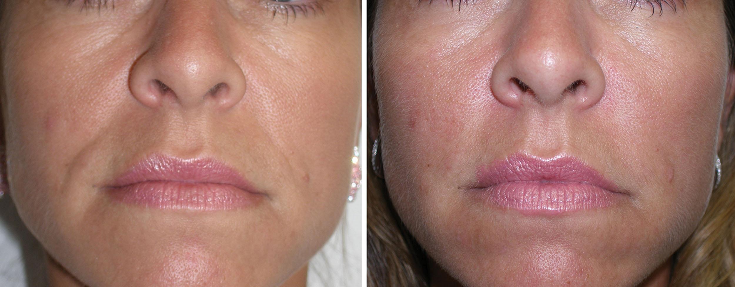 Fig. 10.73, This patient is shown before (left) and after (right) injection of the NLFs with 2 mL of hyaluronic acid filler at one treatment session.