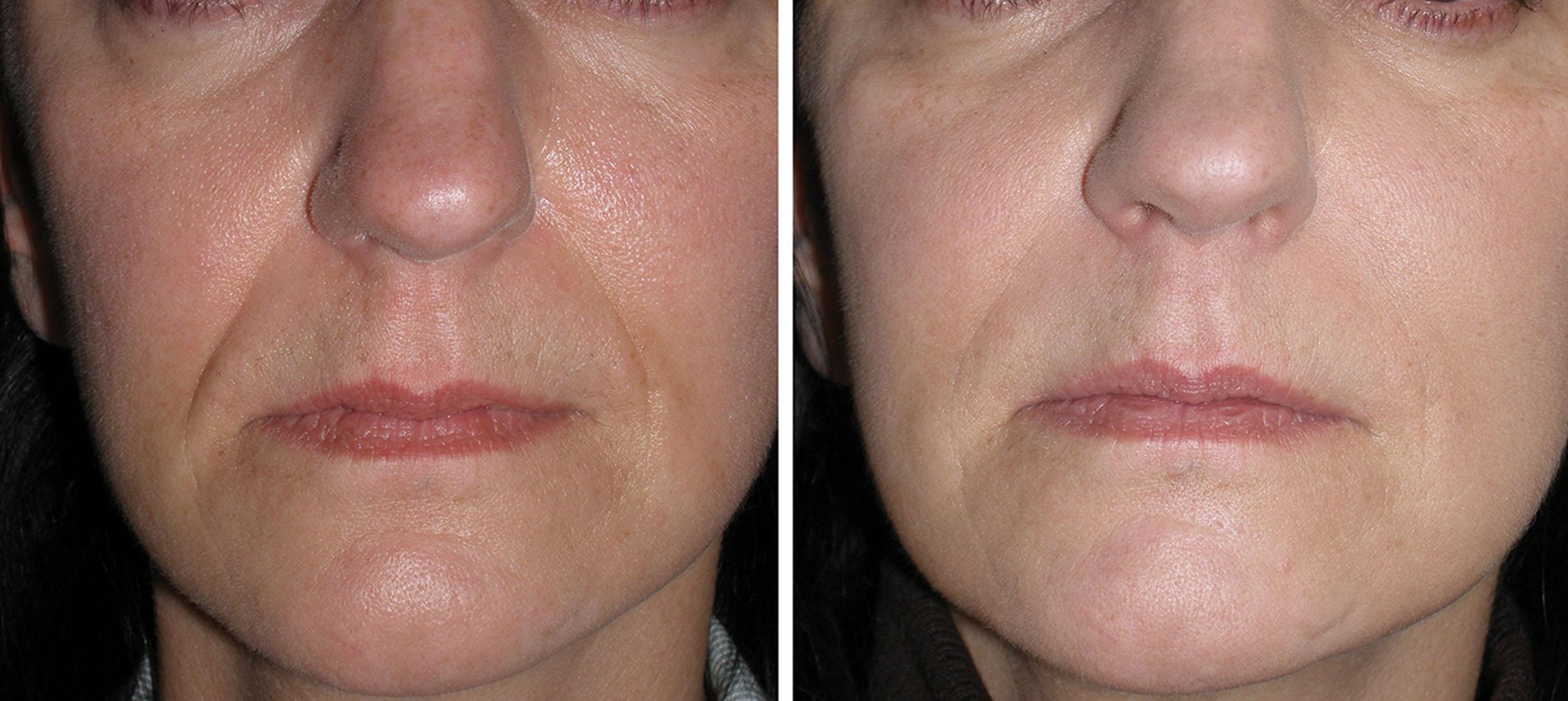Fig. 10.74, This patient is shown before (left) and after (right) several sessions of silicone oil injection to her NLF’s.