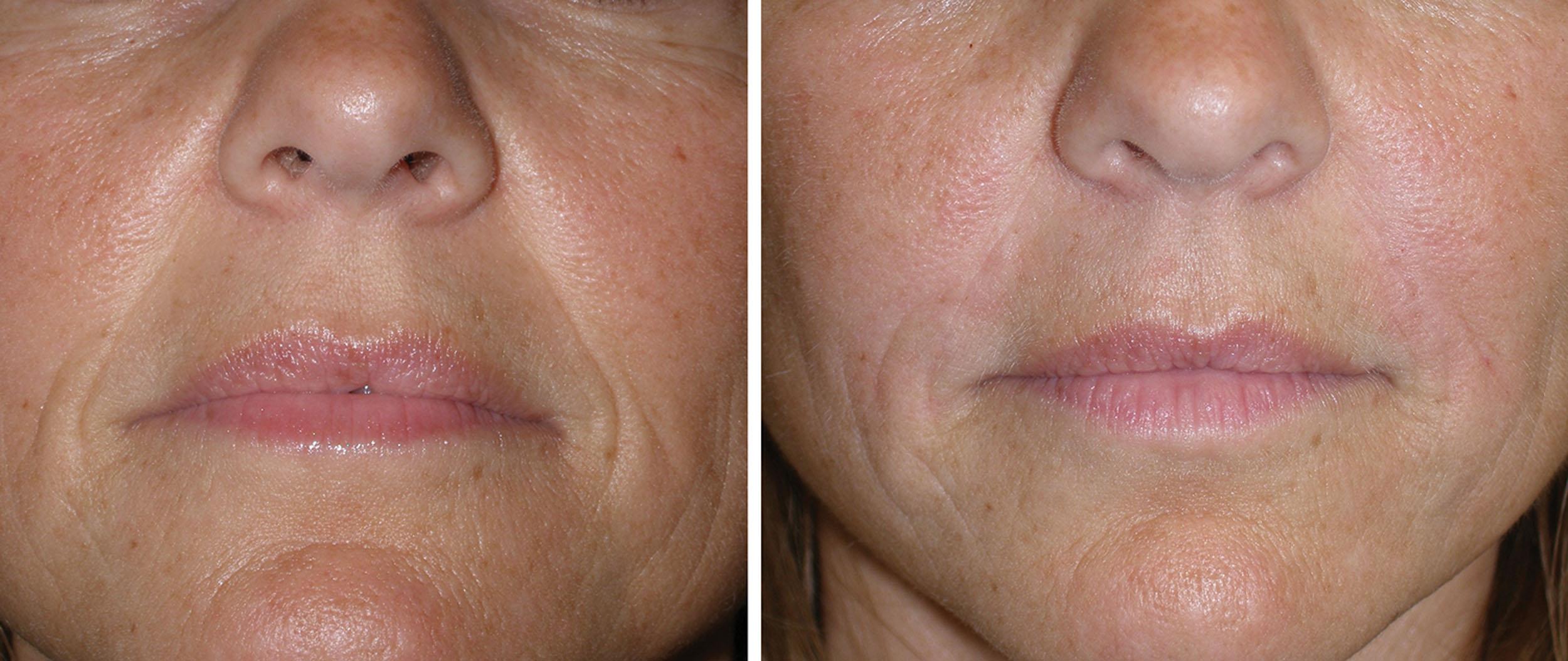 Fig. 10.75, This patient is shown before (left) and after (right) injection of the NLFs with 2 mL of hyaluronic acid filler in a single session.