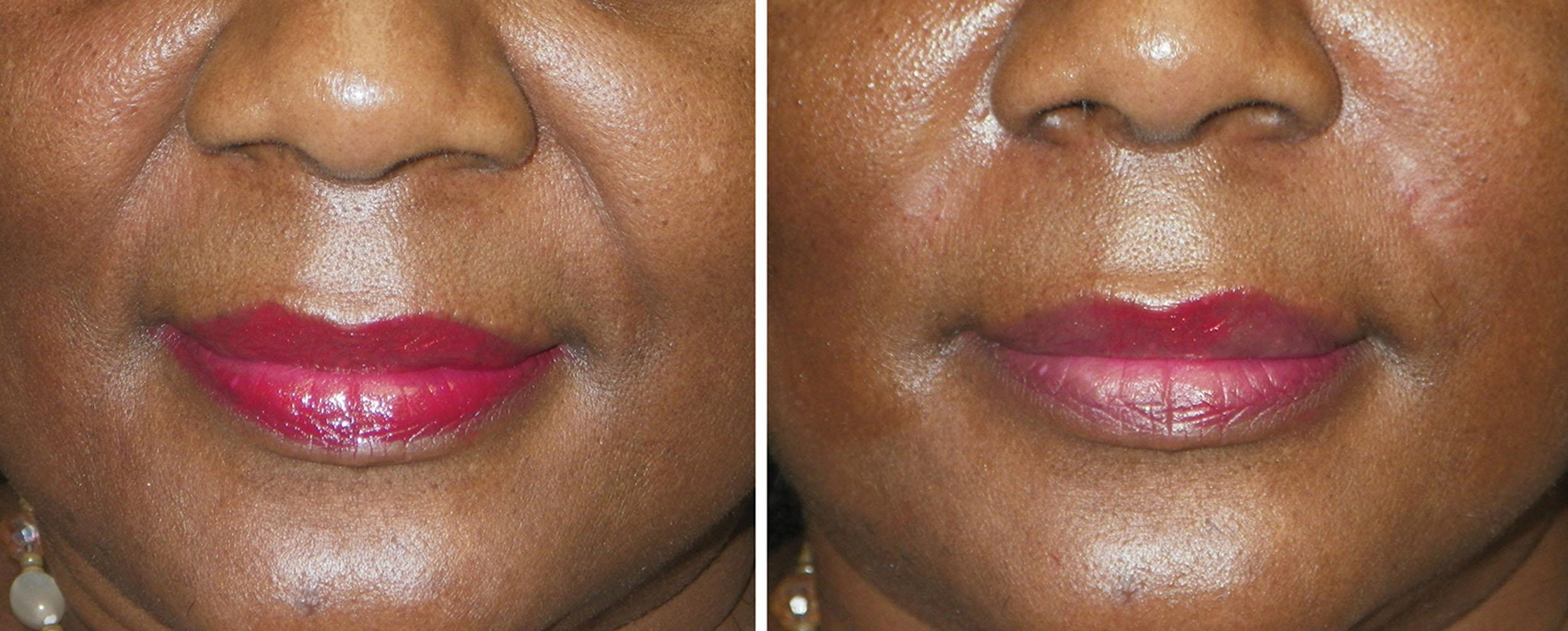 Fig. 10.76, This patient is shown before and after 1 mL of hyaluronic filler in each nasolabial fold.