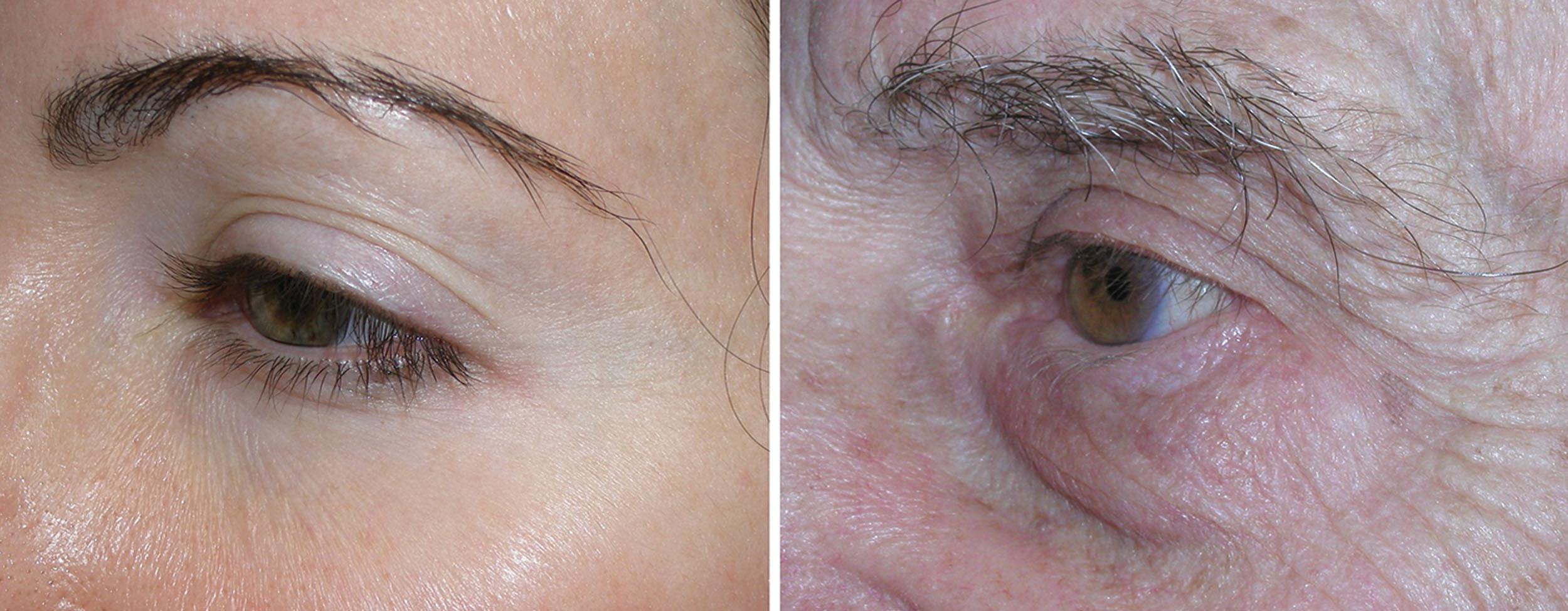 Fig. 10.77, A youthful periorbital complex does not have a deep, defined tear trough (left) . This 80-year-old patient exhibits hard and soft tissue aging changes with a deep visible tear trough (right) .