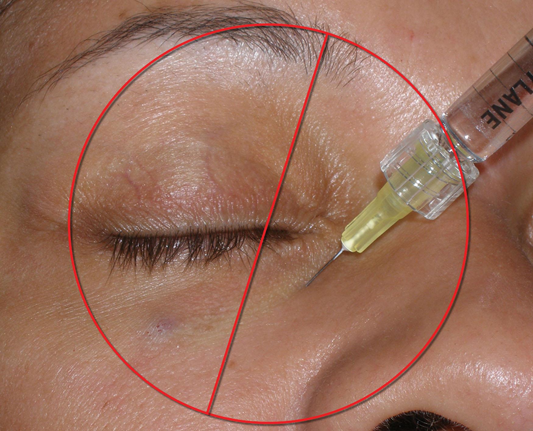 Fig. 10.78, Some injectors prefer filling the tear trough by injecting through the thin lower eyelid skin at the level of the periosteum. I do not recommend this approach and feel that it causes more bruising swelling and discomfort.