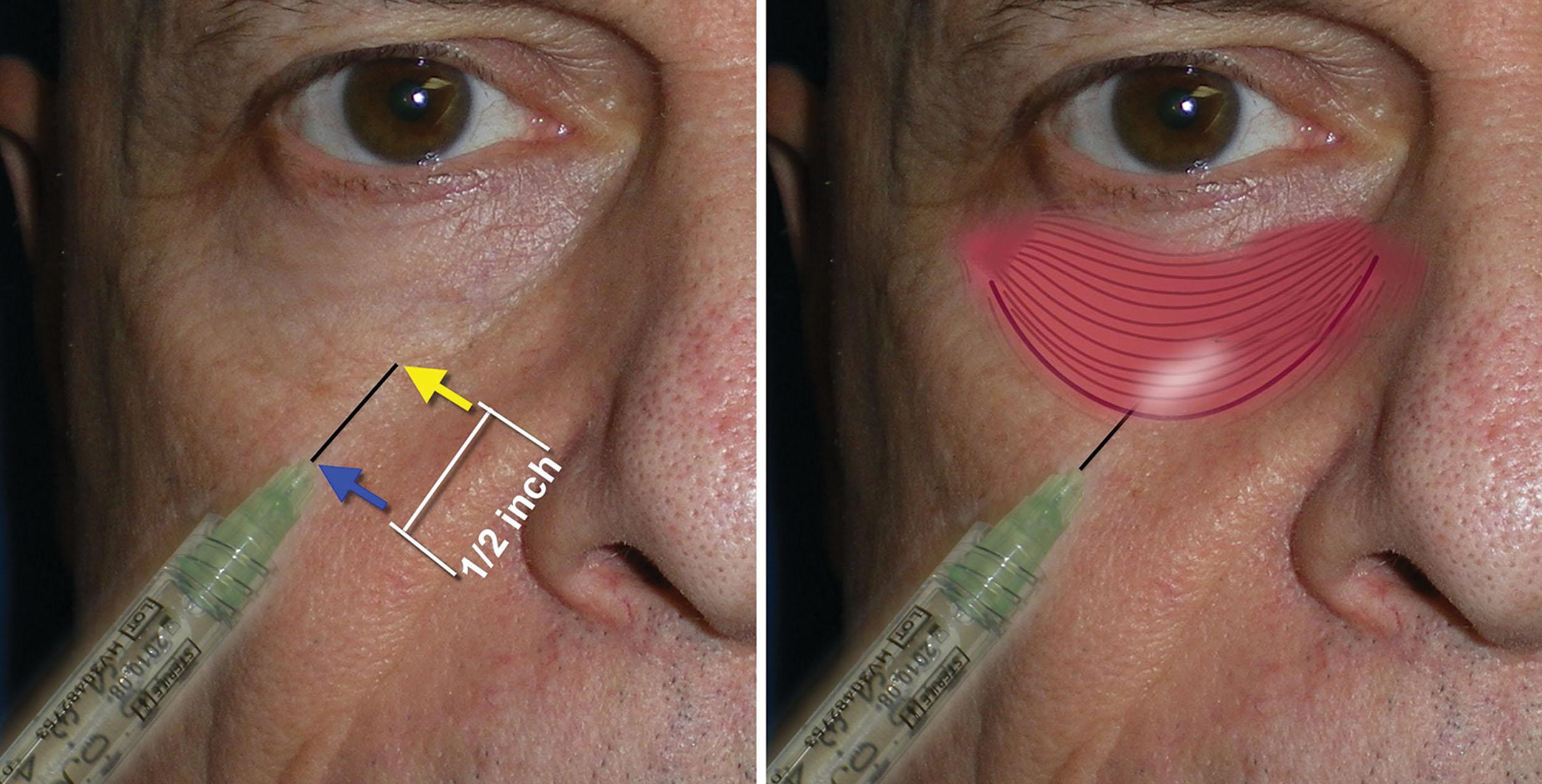 Fig. 10.79, One of the keys to successful tear trough filling to minimize swelling and bruising is to minimize the number of needle entry points. Instead of injecting four or five regions across the lower orbital rim, the needle is placed through the thicker and less vascular cheek skin. The needle is inserted ½ inch distal to the intended target and extended the full length. Staying below the level of the orbicularis oculi muscle reduces irregularities that may otherwise be visible through the thin lower lid skin. It also discourages the Tyndall (or Raleigh) effect in which a bluish hue is seen below the skin.