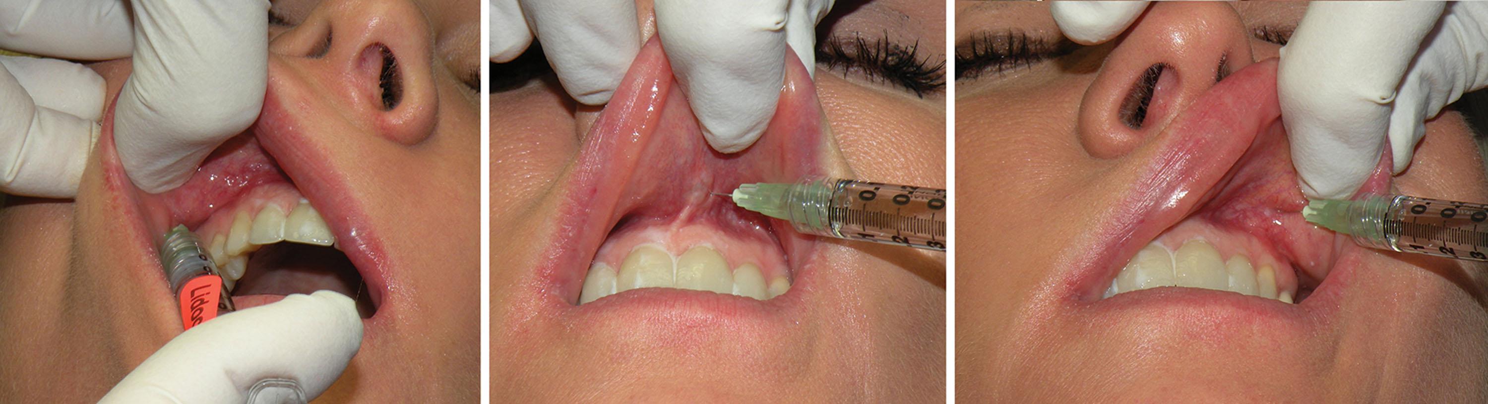 Fig. 10.8, The upper lip is treated with 0.2-mL aliquots of 2% xylocaine with 1:100, 000 epinephrine in several areas just above the sulcus from the canine tooth on one side to the canine tooth on the contralateral side.