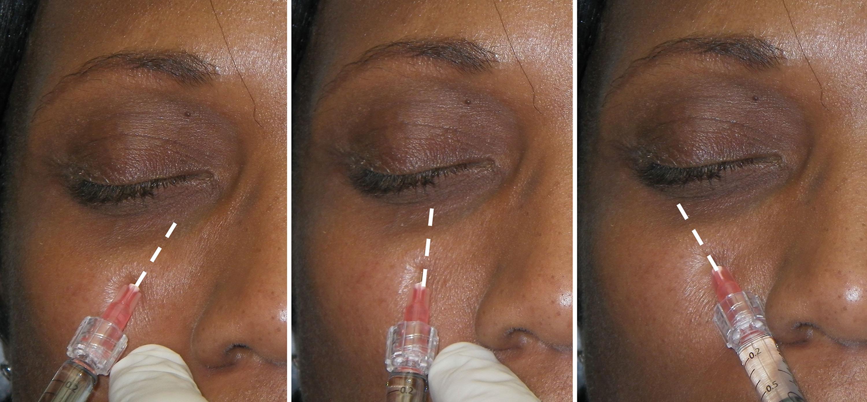 Fig. 10.81, Minimizing the number of needle sticks is imperative to successful treatment with less swelling and bruising. Most of the tear trough can be injected through a single needle stick in which the entry point is central and the needle is withdrawn almost to the entry point and redirected to the medial and lateral tear trough, without withdrawing from the skin.