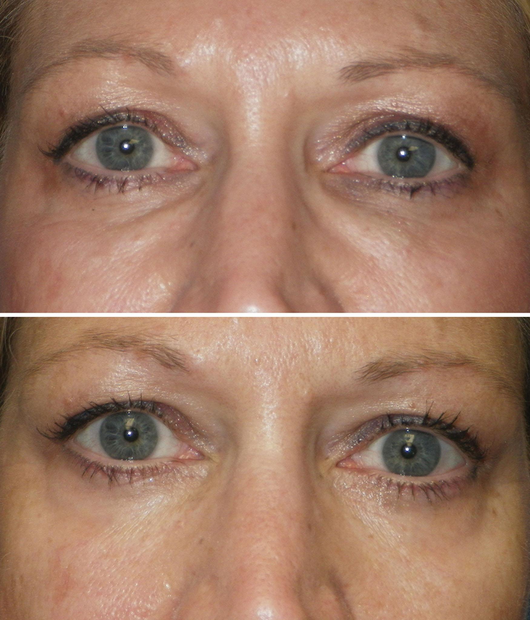 Fig. 10.82, A 45 year-old patient is shown before (top) and after (bottom) tear trough filler treatment with 2 mL of hyaluronic acid filler.