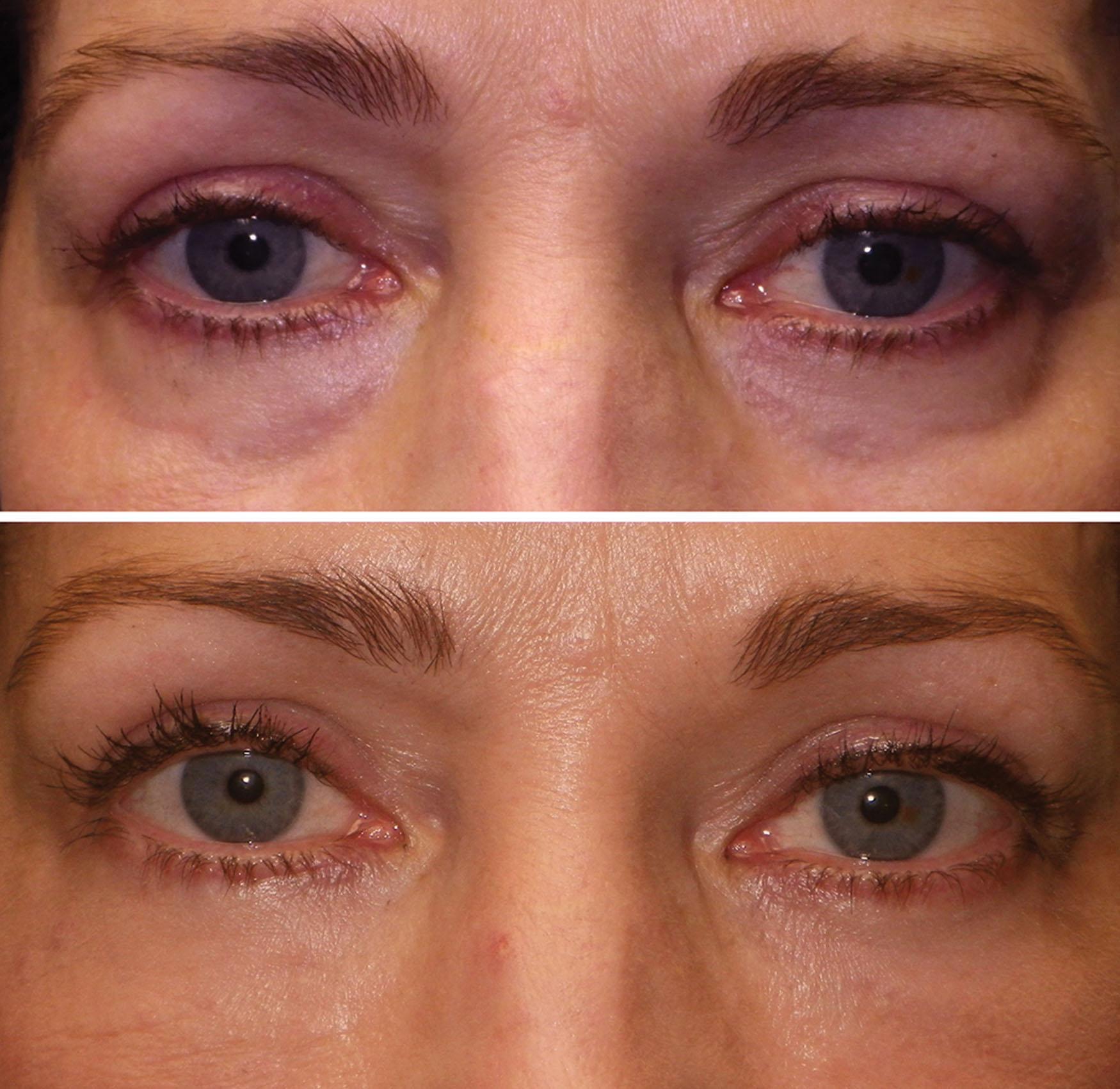 Fig. 10.83, A patient is shown before (top) and after (bottom) tear trough filler treatment with 2 mL of hyaluronic acid filler.